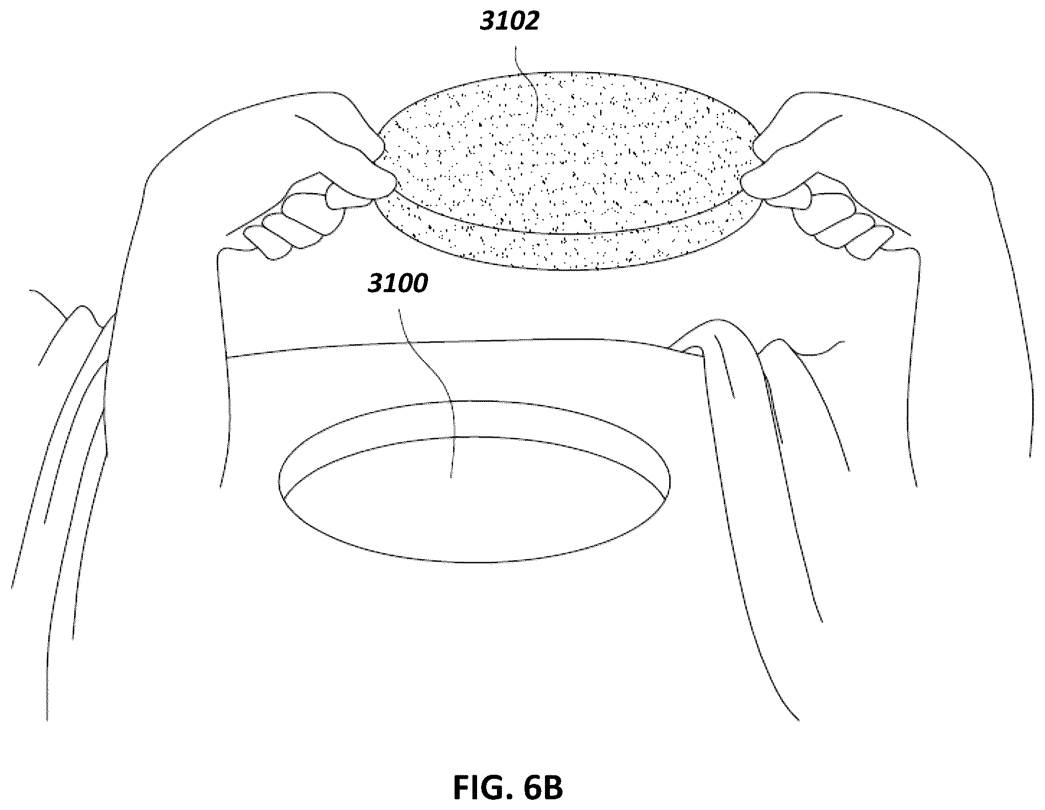 Patent US12097096 Figure 7 – Customizable wound closure device and method of use