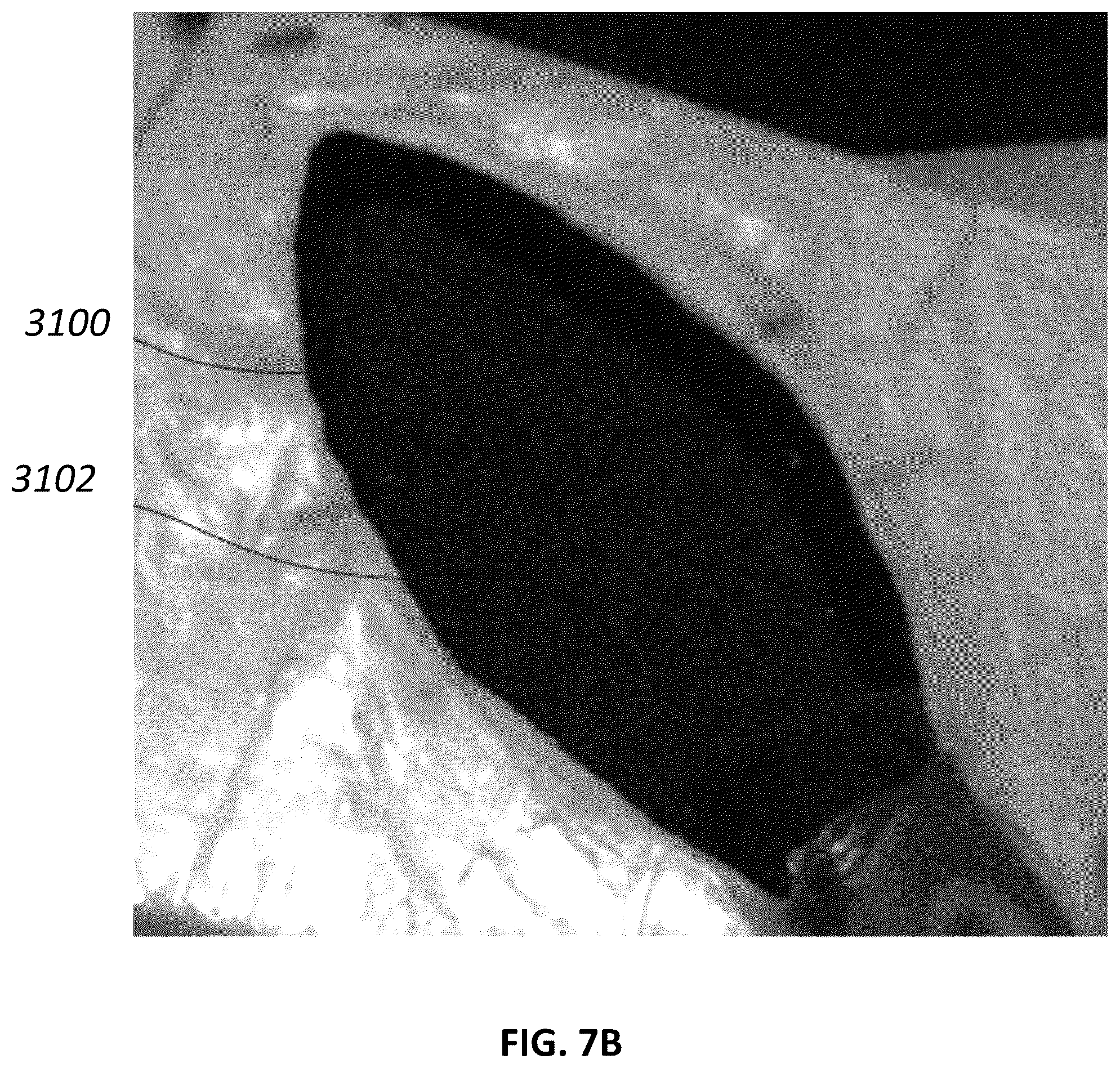 Patent US12097096 Figure 9 – Customizable wound closure device and method of use