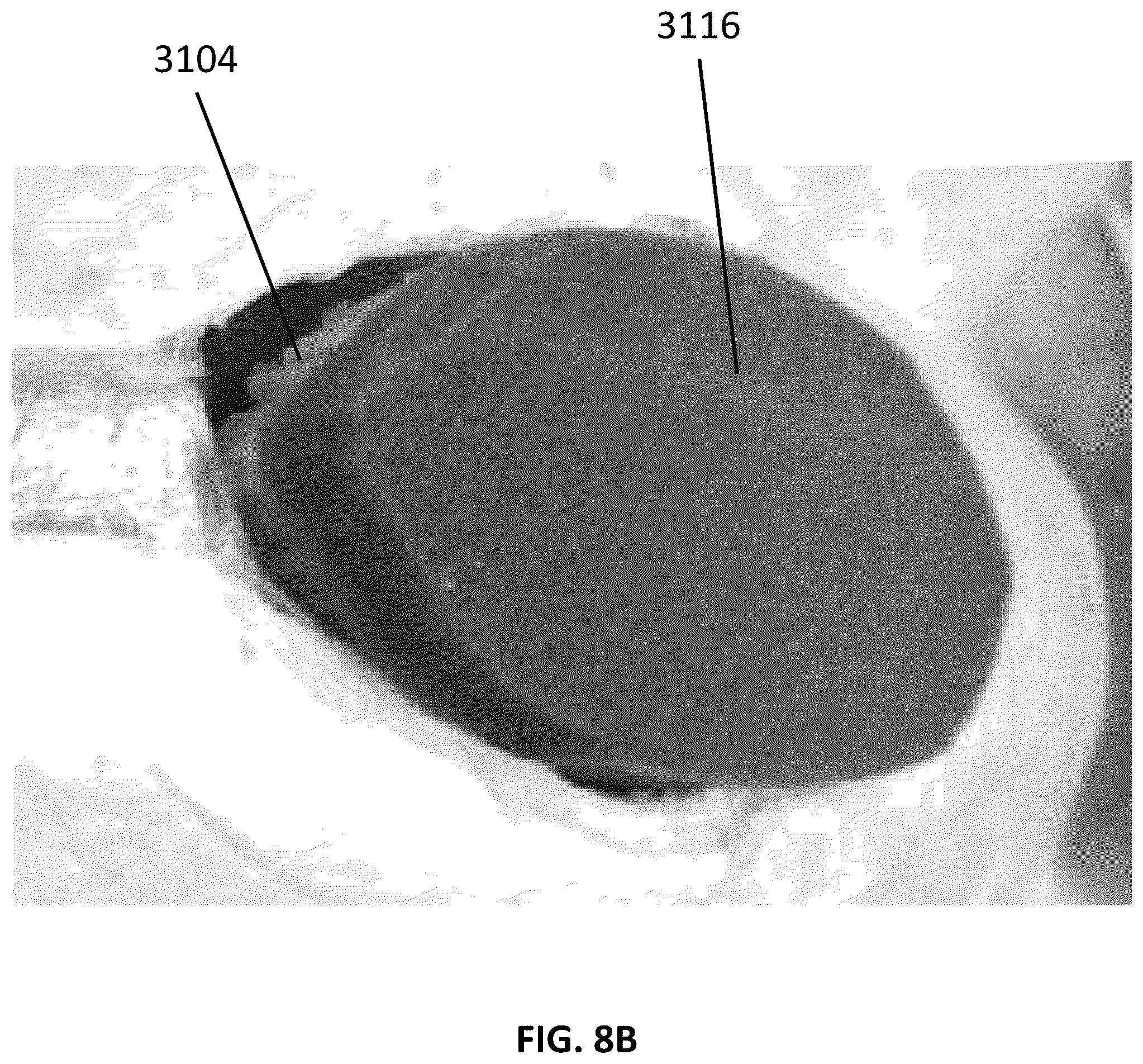 Patent US12097096 Figure 11 – Customizable wound closure device and method of use