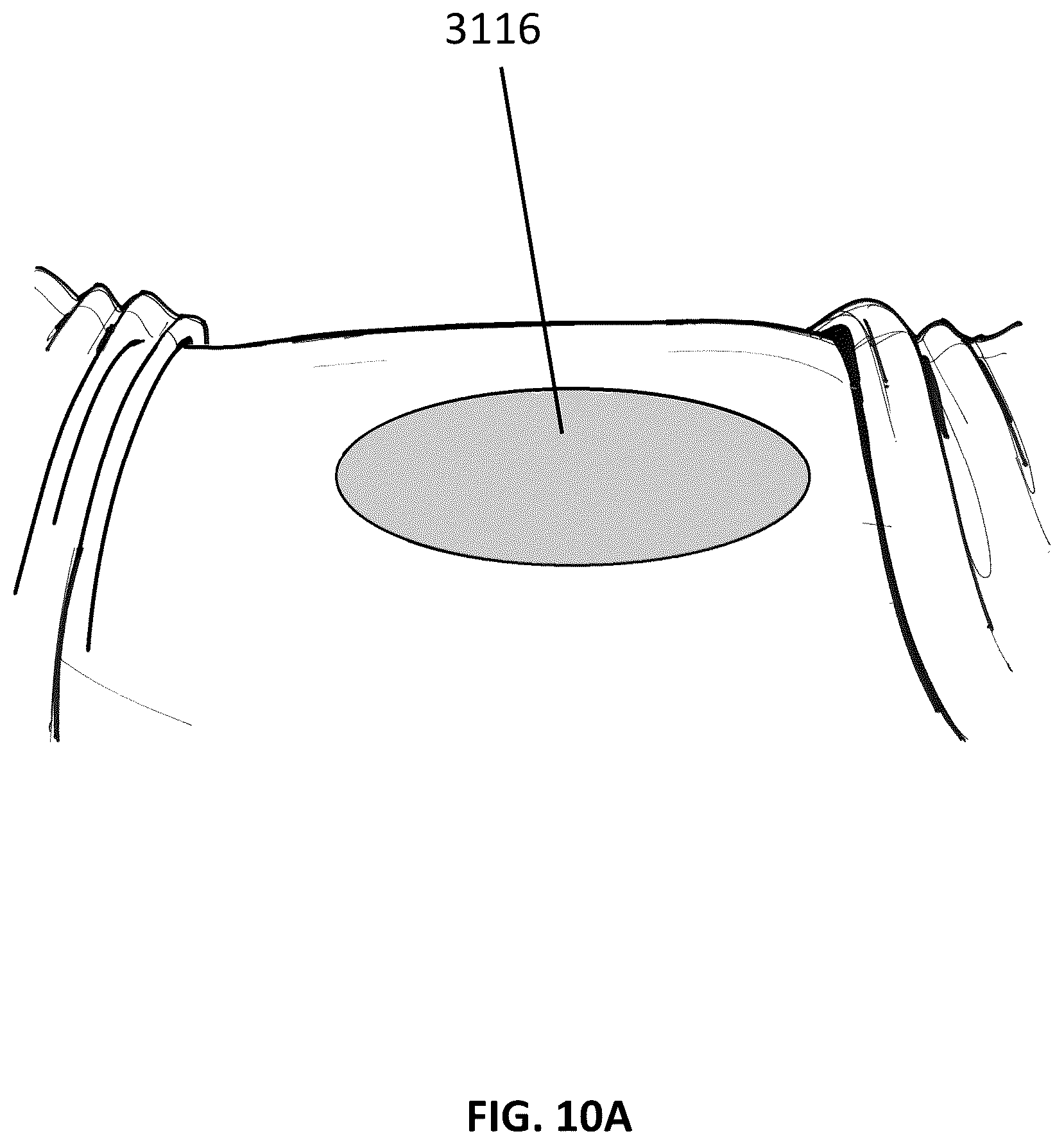 Patent US12097096 Figure 14 – Customizable wound closure device and method of use
