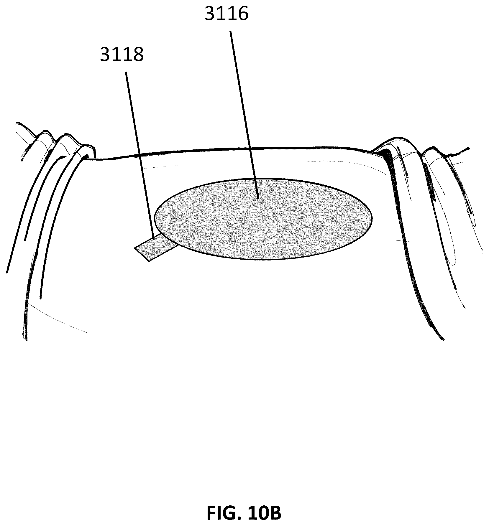 Patent US12097096 Figure 15 – Customizable wound closure device and method of use