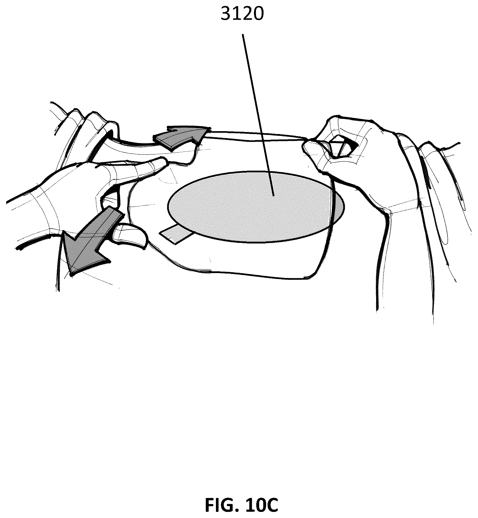 Patent US12097096 Figure 16 – Customizable wound closure device and method of use