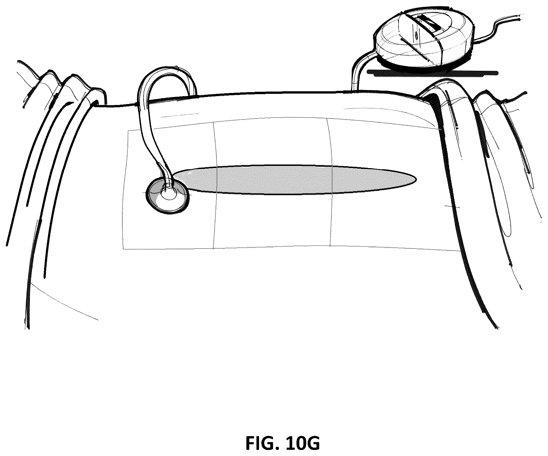 Patent US12097096 Figure 20 – Customizable wound closure device and method of use