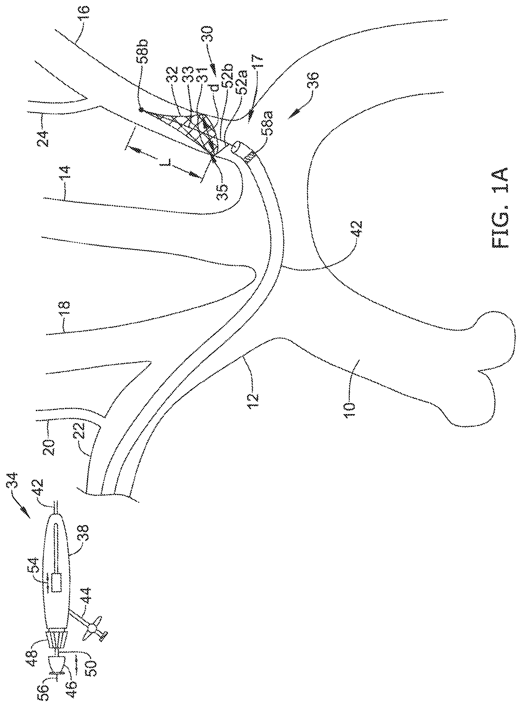 Patent US12097108 Figure 1 – Systems and methods for protecting the cerebral vasculature