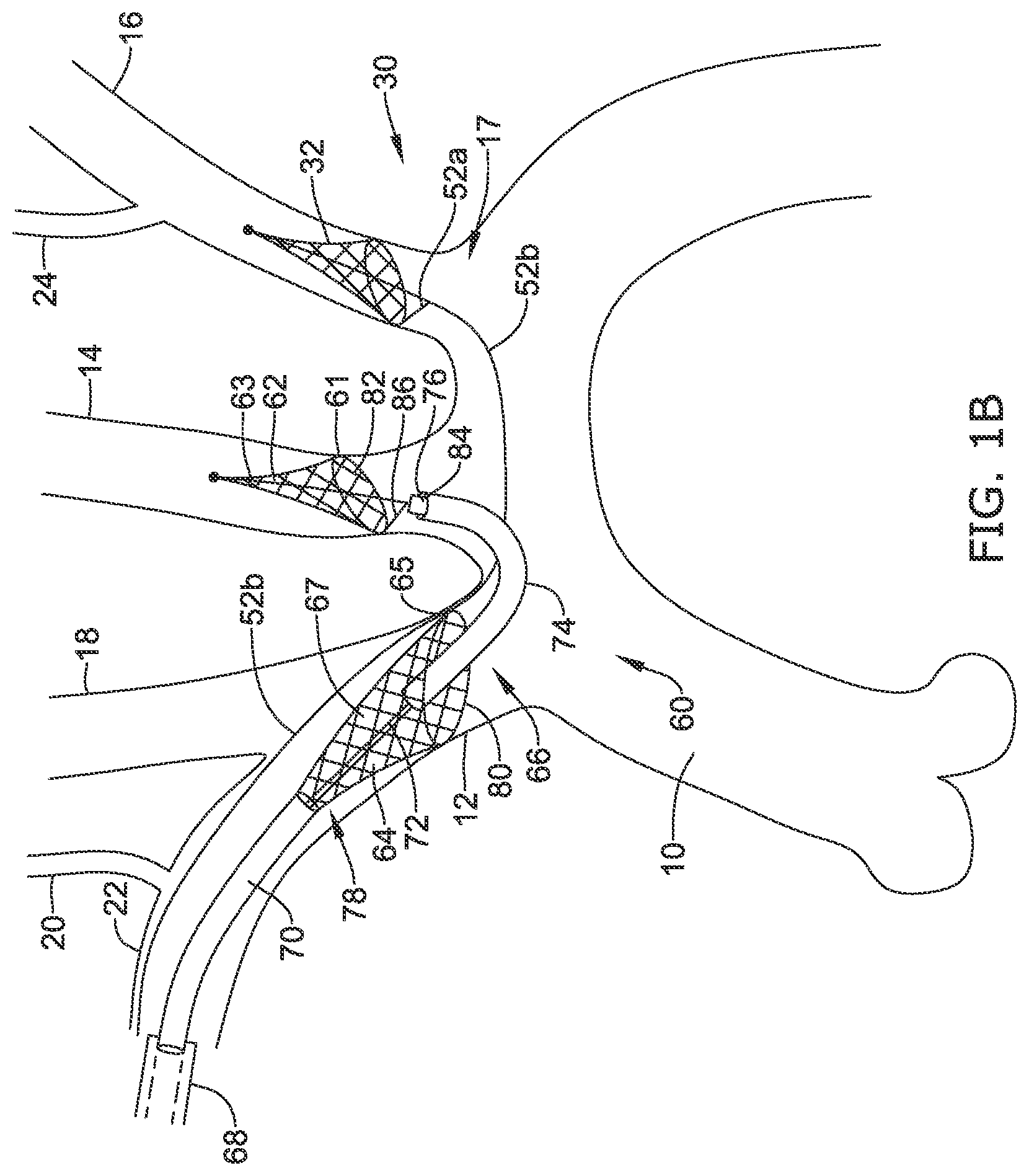 Patent US12097108 Figure 2 – Systems and methods for protecting the cerebral vasculature