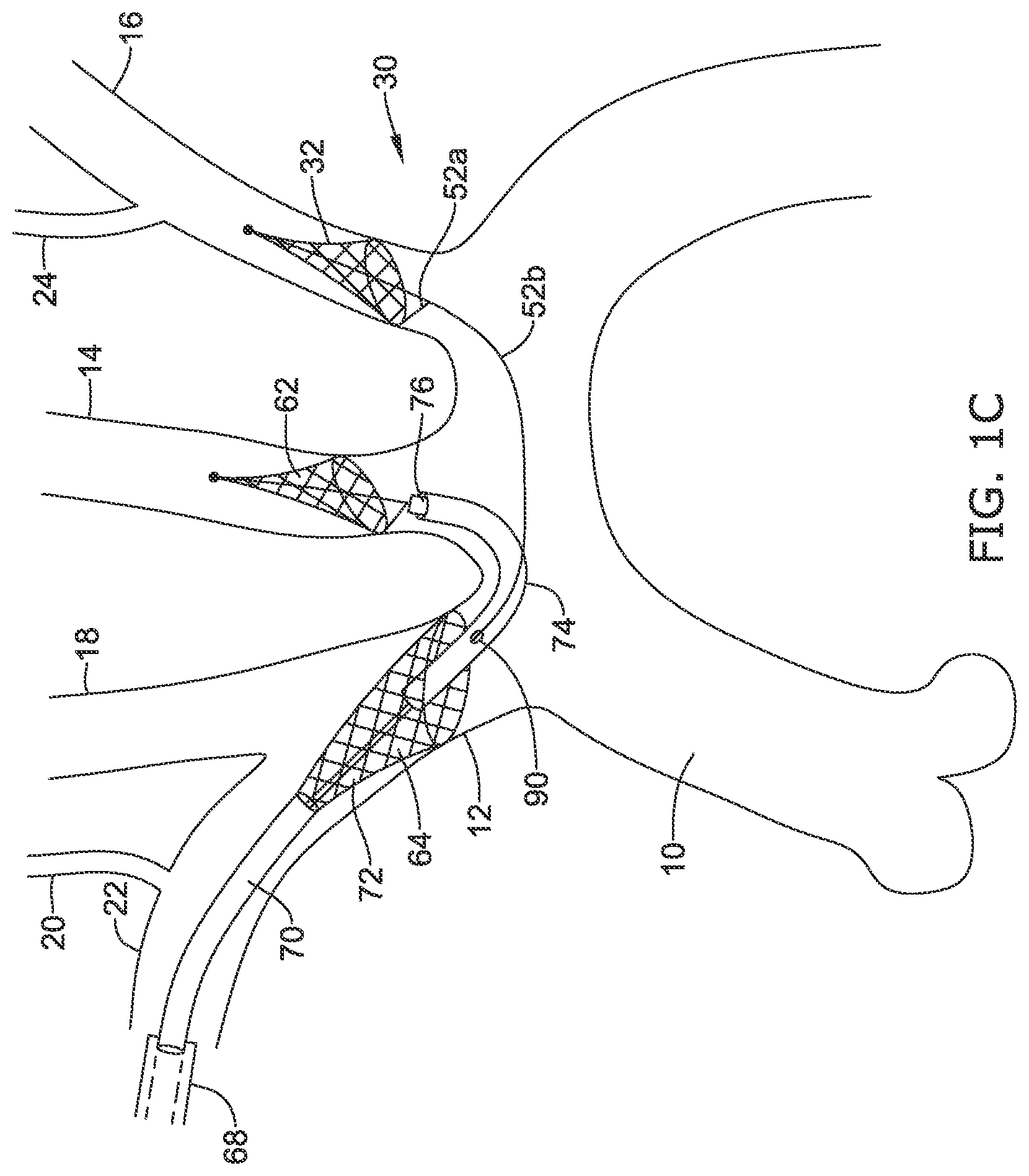 Patent US12097108 Figure 3 – Systems and methods for protecting the cerebral vasculature