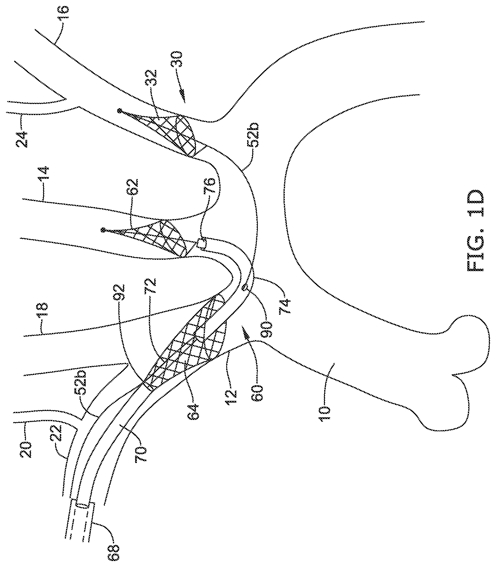 Patent US12097108 Figure 4 – Systems and methods for protecting the cerebral vasculature