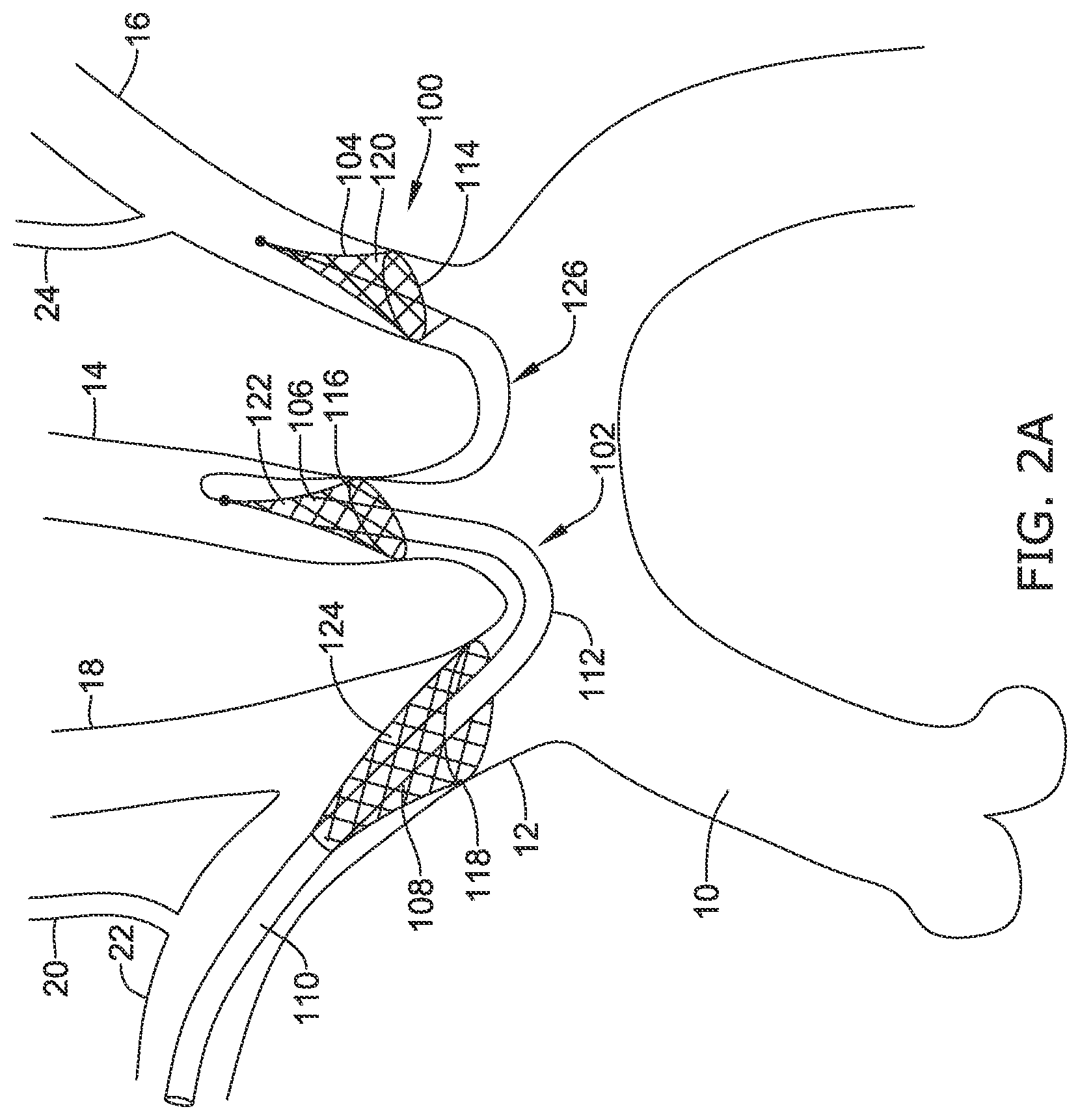 Patent US12097108 Figure 6 – Systems and methods for protecting the cerebral vasculature