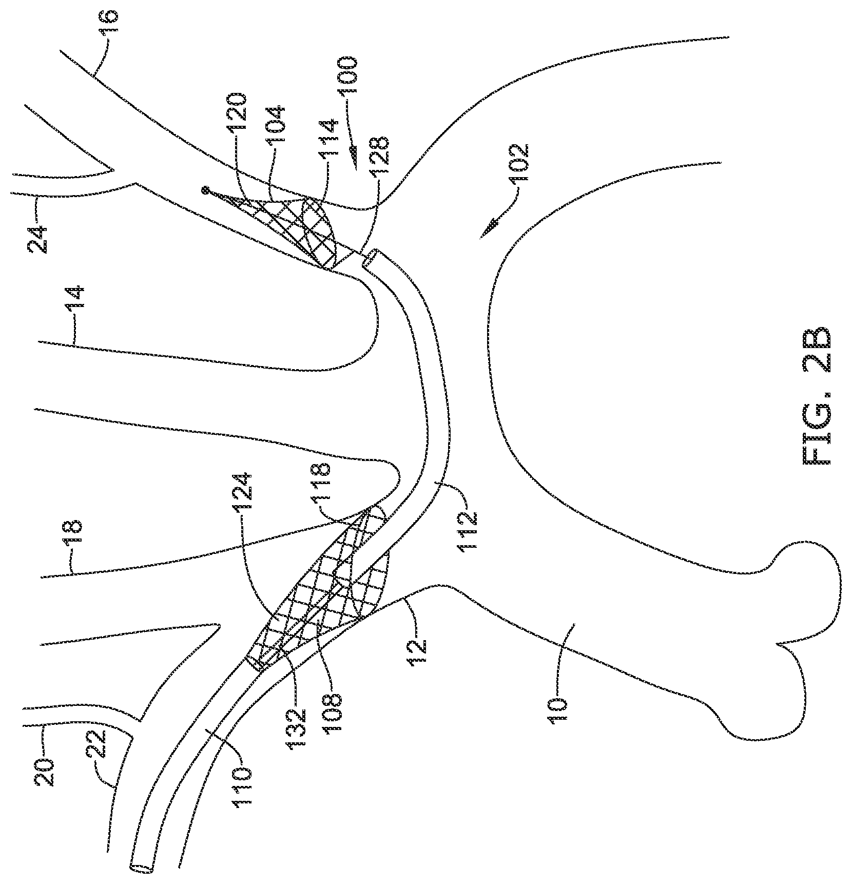 Patent US12097108 Figure 7 – Systems and methods for protecting the cerebral vasculature
