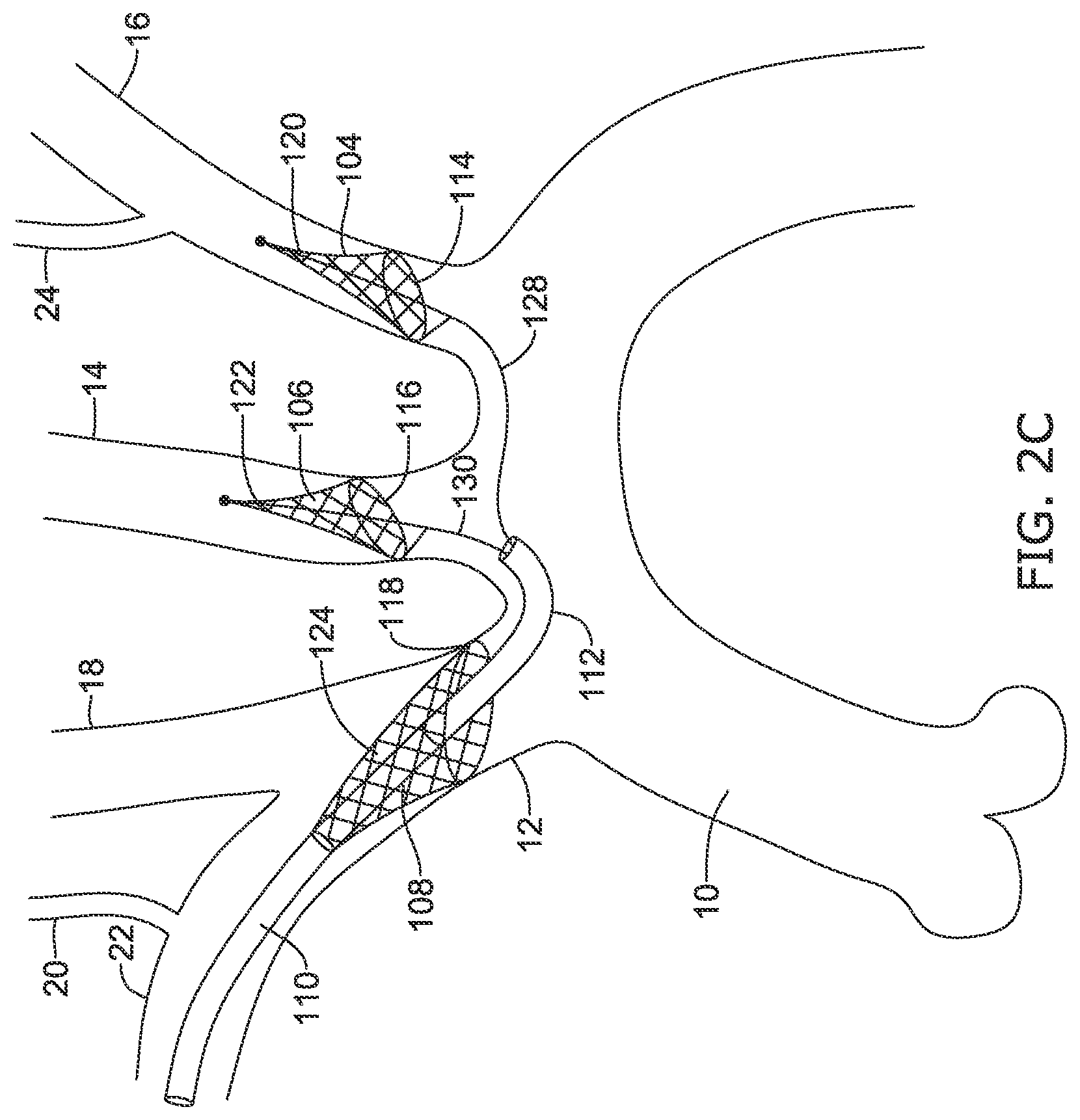 Patent US12097108 Figure 8 – Systems and methods for protecting the cerebral vasculature