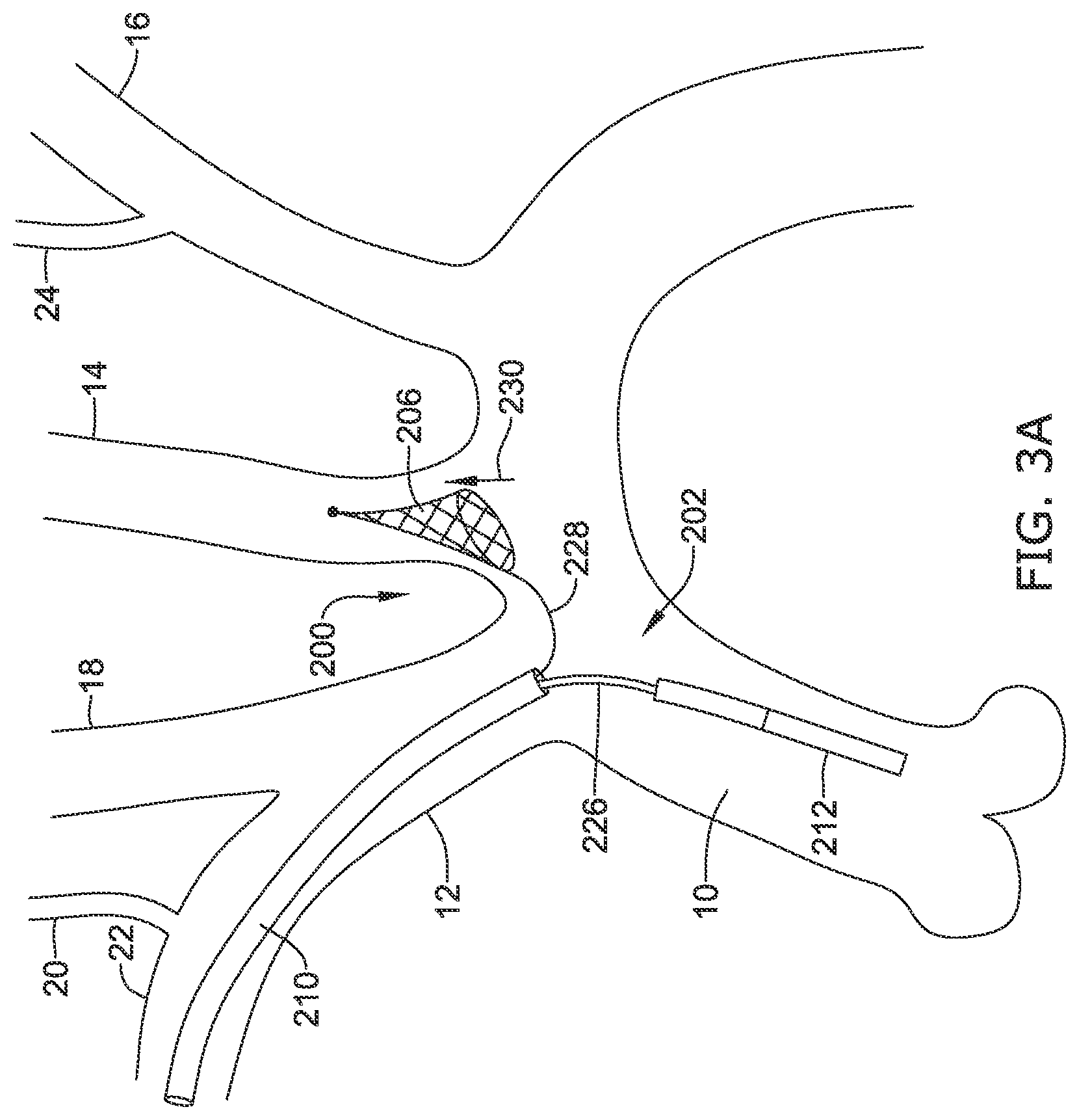 Patent US12097108 Figure 9 – Systems and methods for protecting the cerebral vasculature