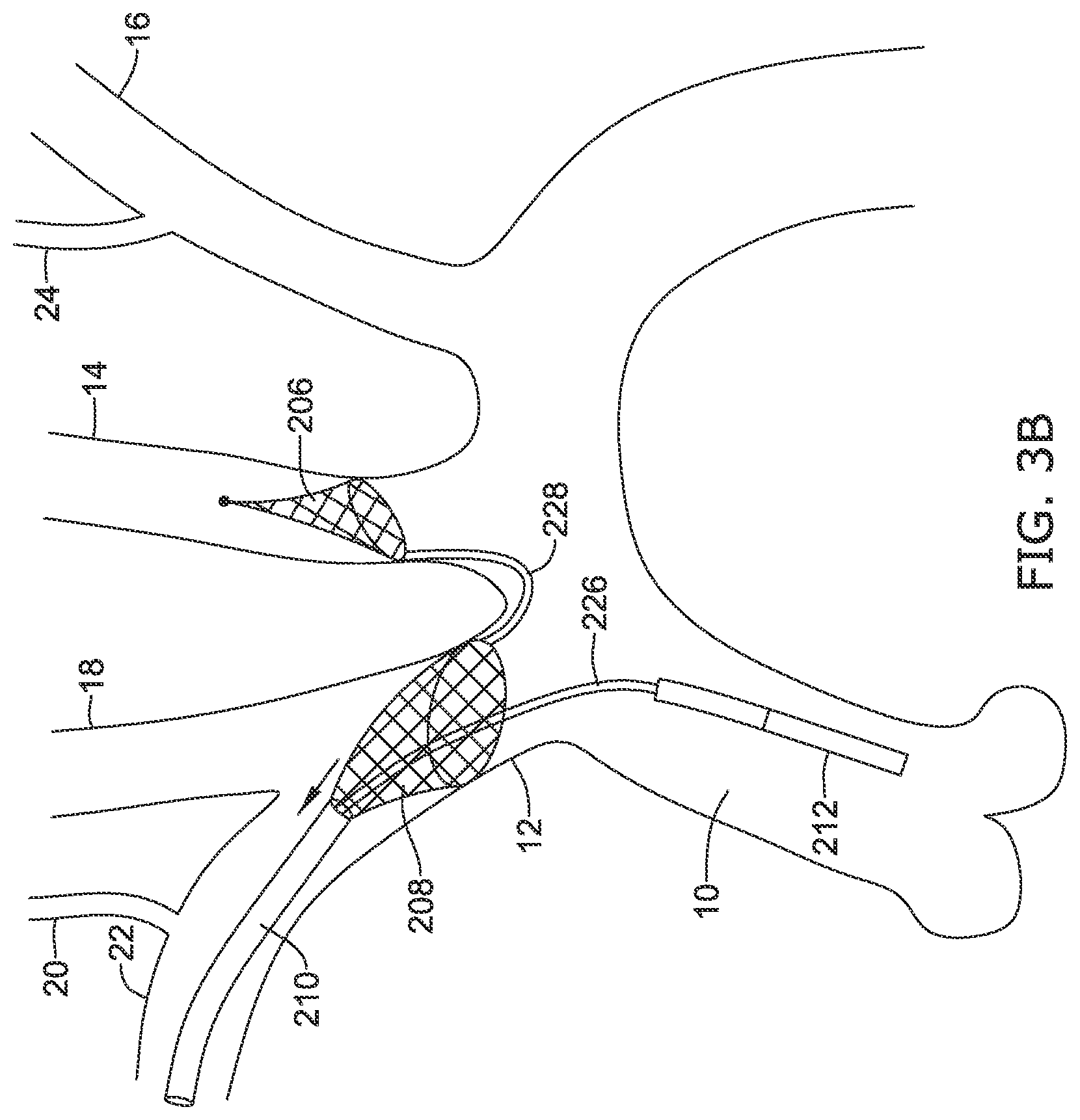 Patent US12097108 Figure 10 – Systems and methods for protecting the cerebral vasculature