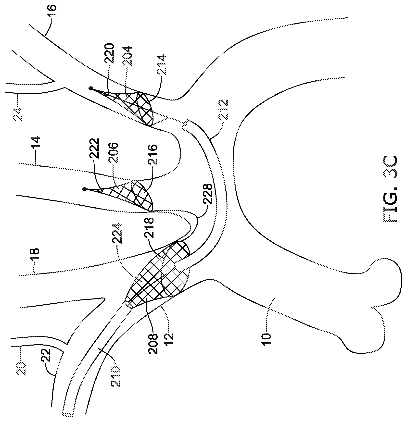 Patent US12097108 Figure 11 – Systems and methods for protecting the cerebral vasculature