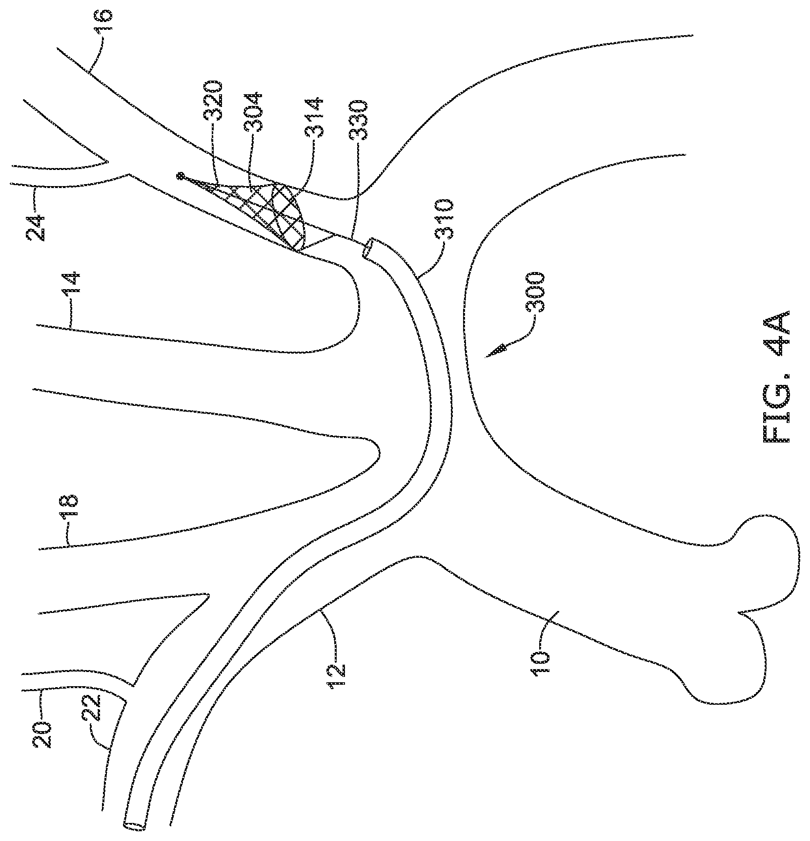 Patent US12097108 Figure 12 – Systems and methods for protecting the cerebral vasculature