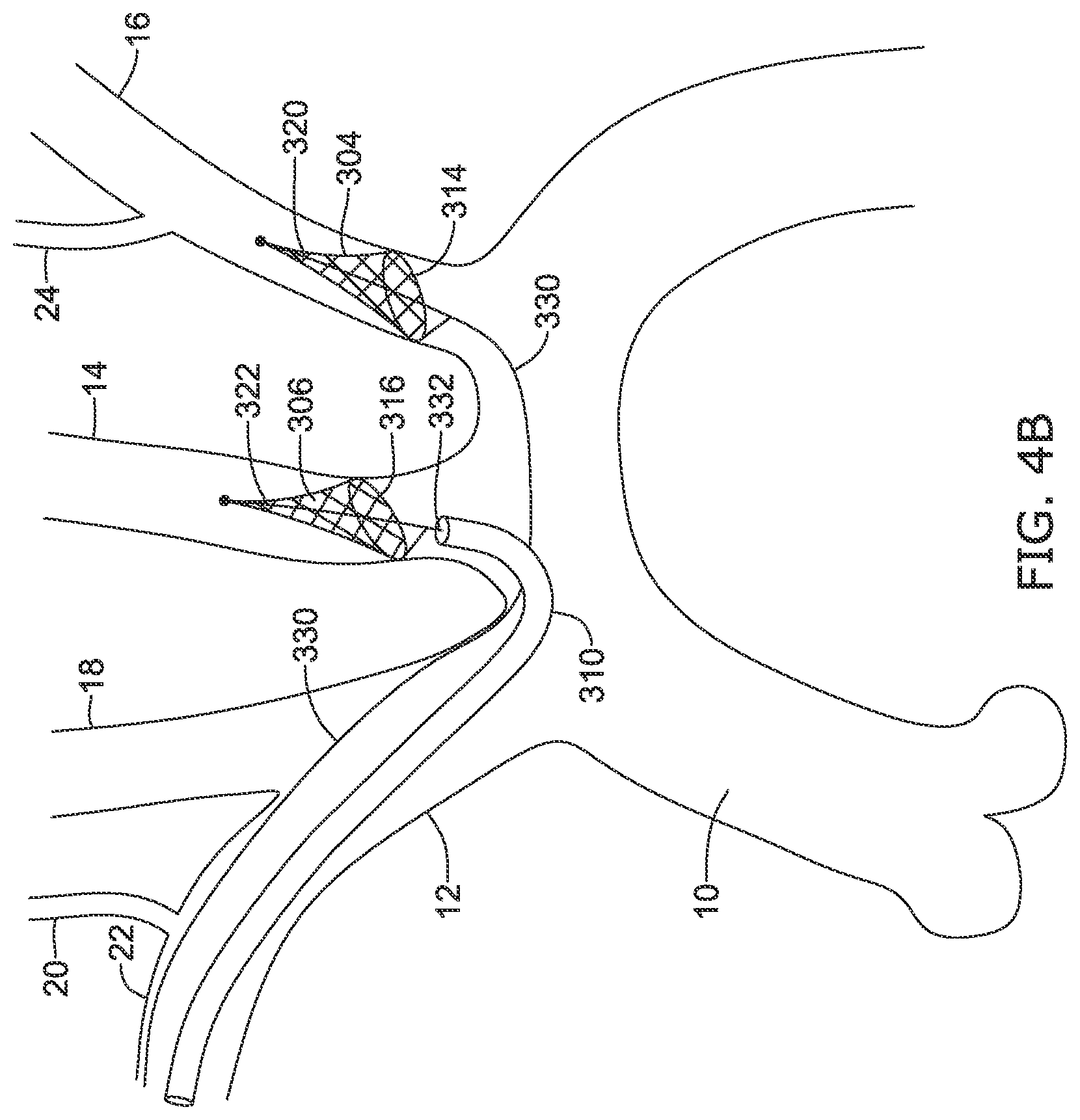 Patent US12097108 Figure 13 – Systems and methods for protecting the cerebral vasculature