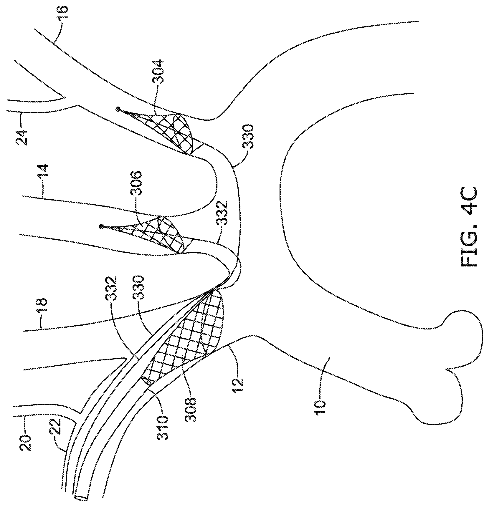 Patent US12097108 Figure 14 – Systems and methods for protecting the cerebral vasculature