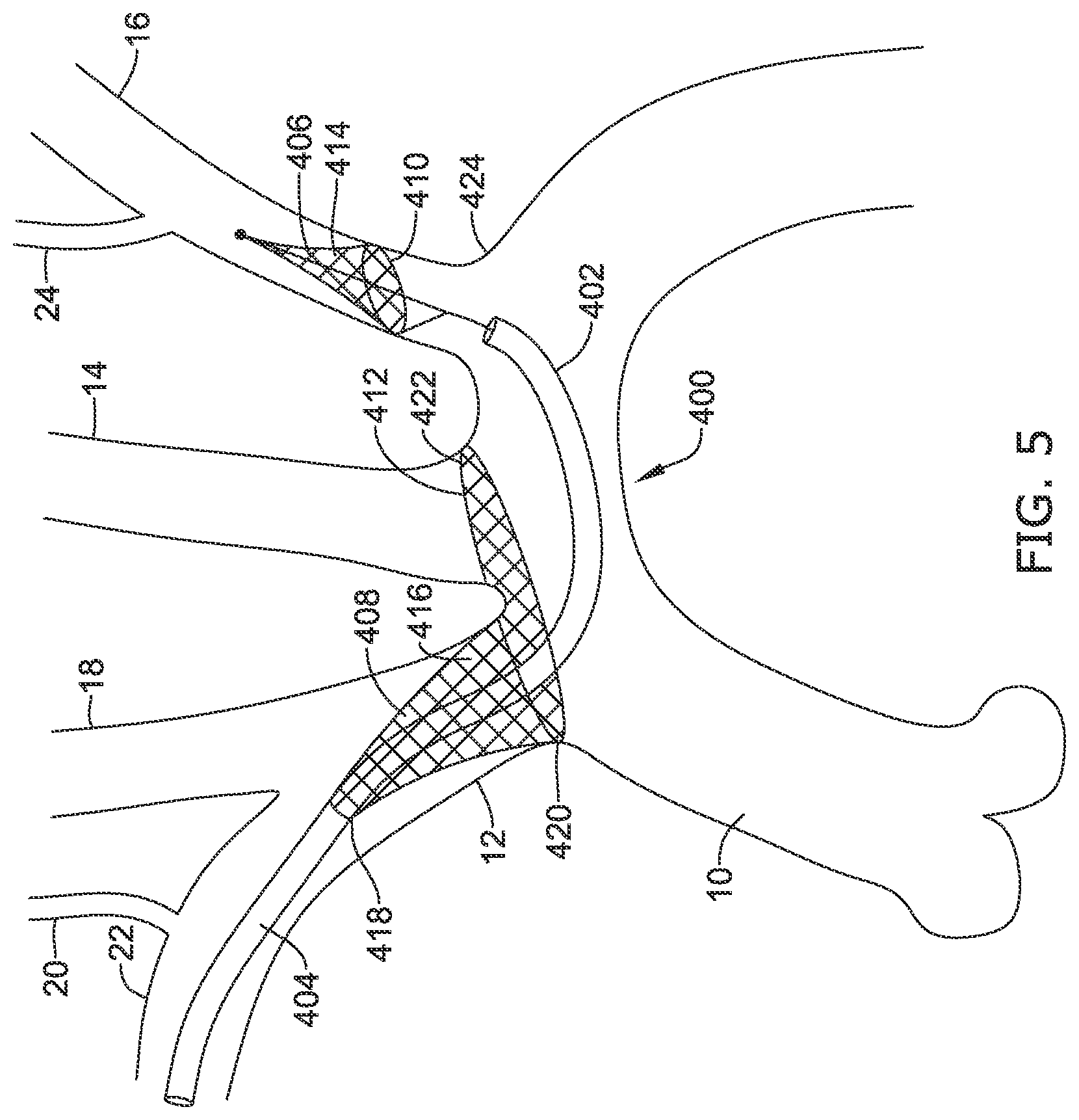 Patent US12097108 Figure 15 – Systems and methods for protecting the cerebral vasculature