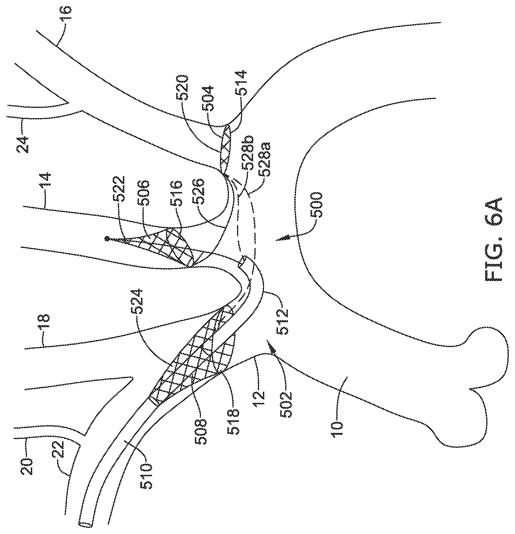 Patent US12097108 Figure 16 – Systems and methods for protecting the cerebral vasculature