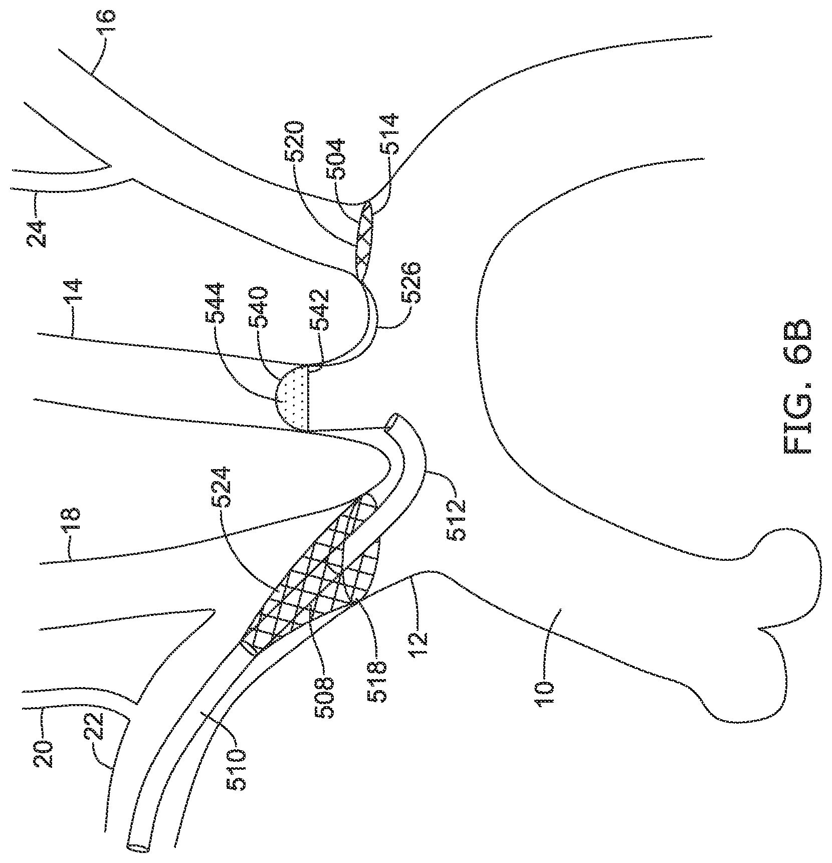Patent US12097108 Figure 17 – Systems and methods for protecting the cerebral vasculature