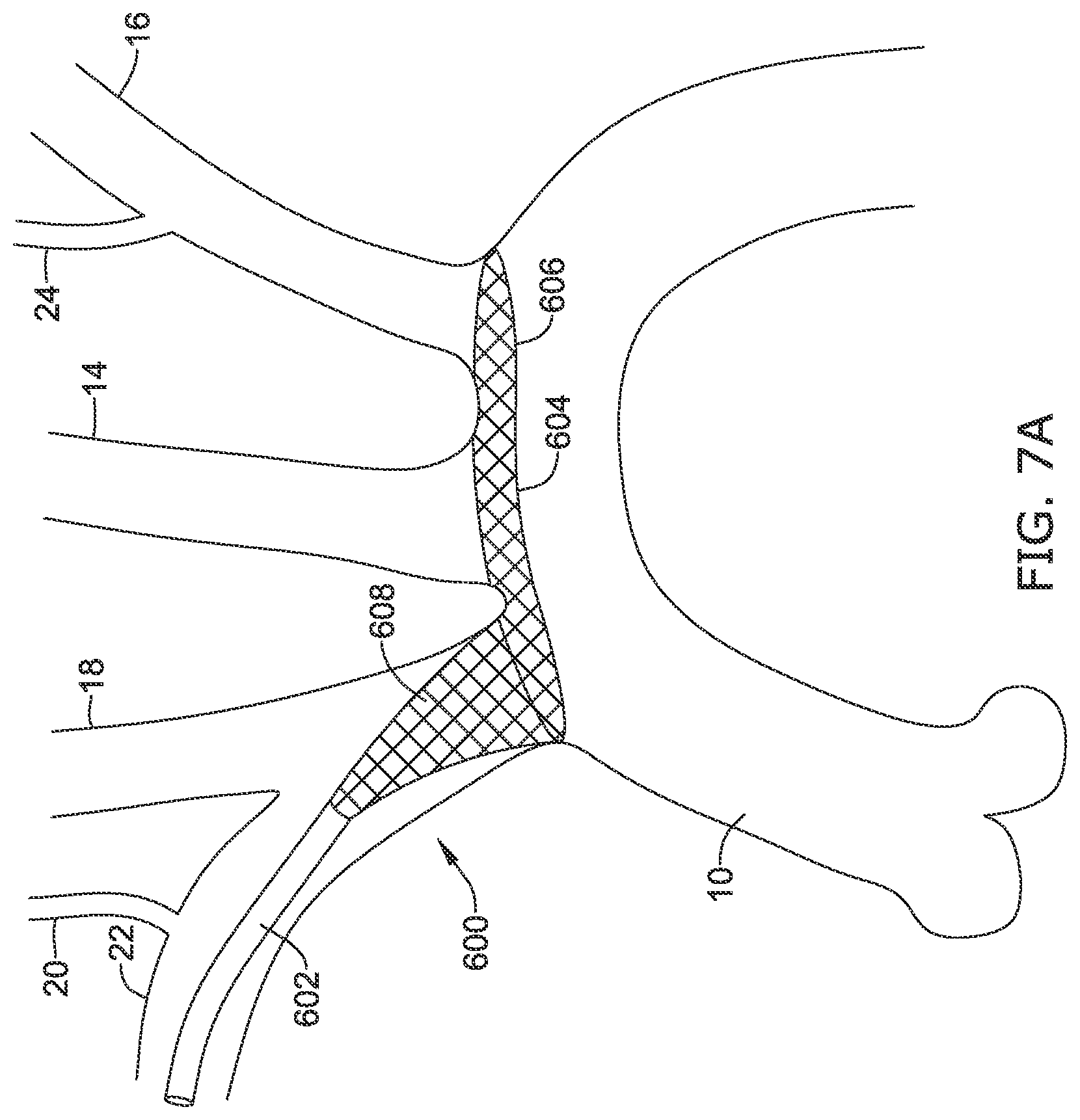Patent US12097108 Figure 18 – Systems and methods for protecting the cerebral vasculature