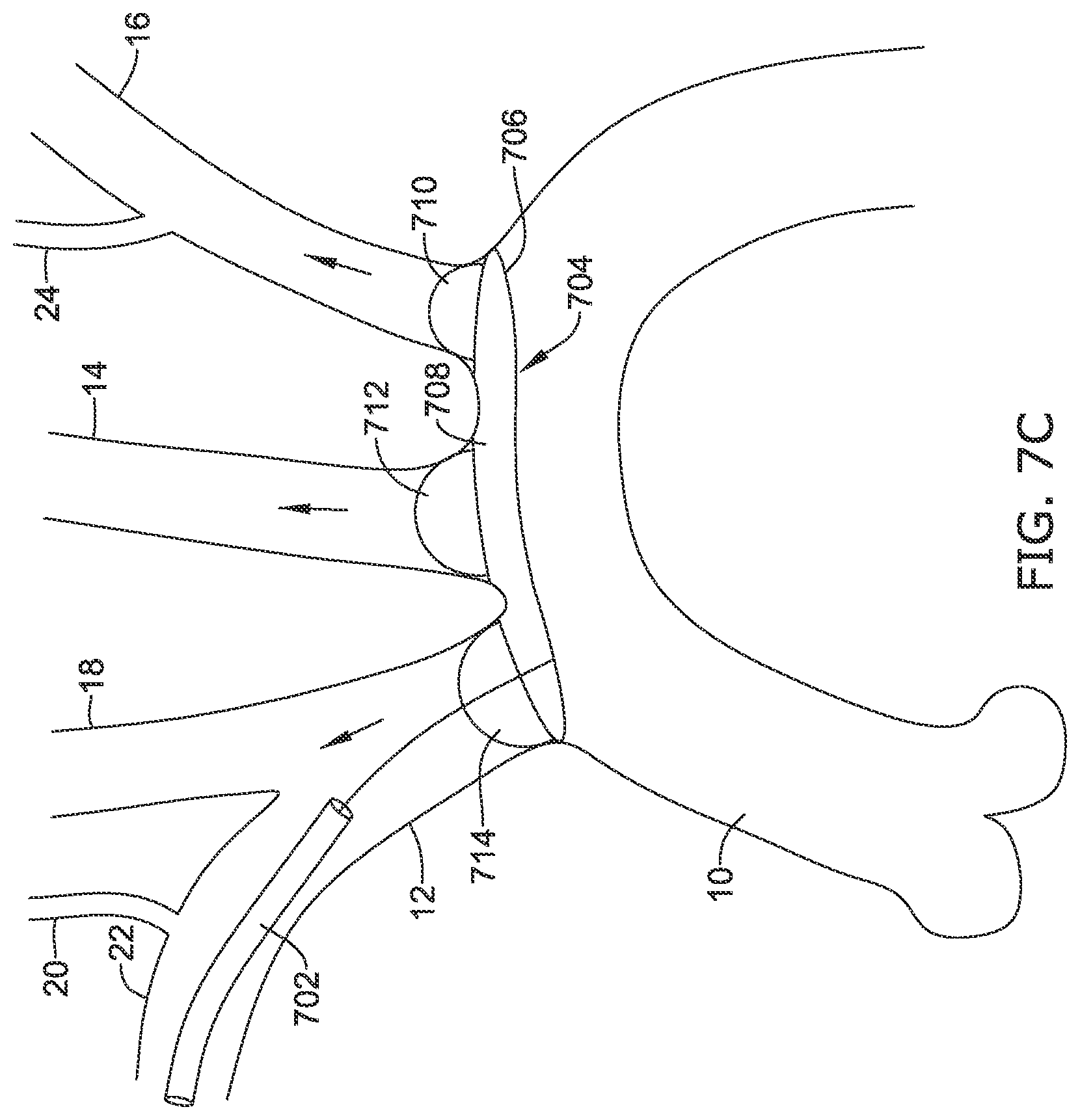 Patent US12097108 Figure 20 – Systems and methods for protecting the cerebral vasculature