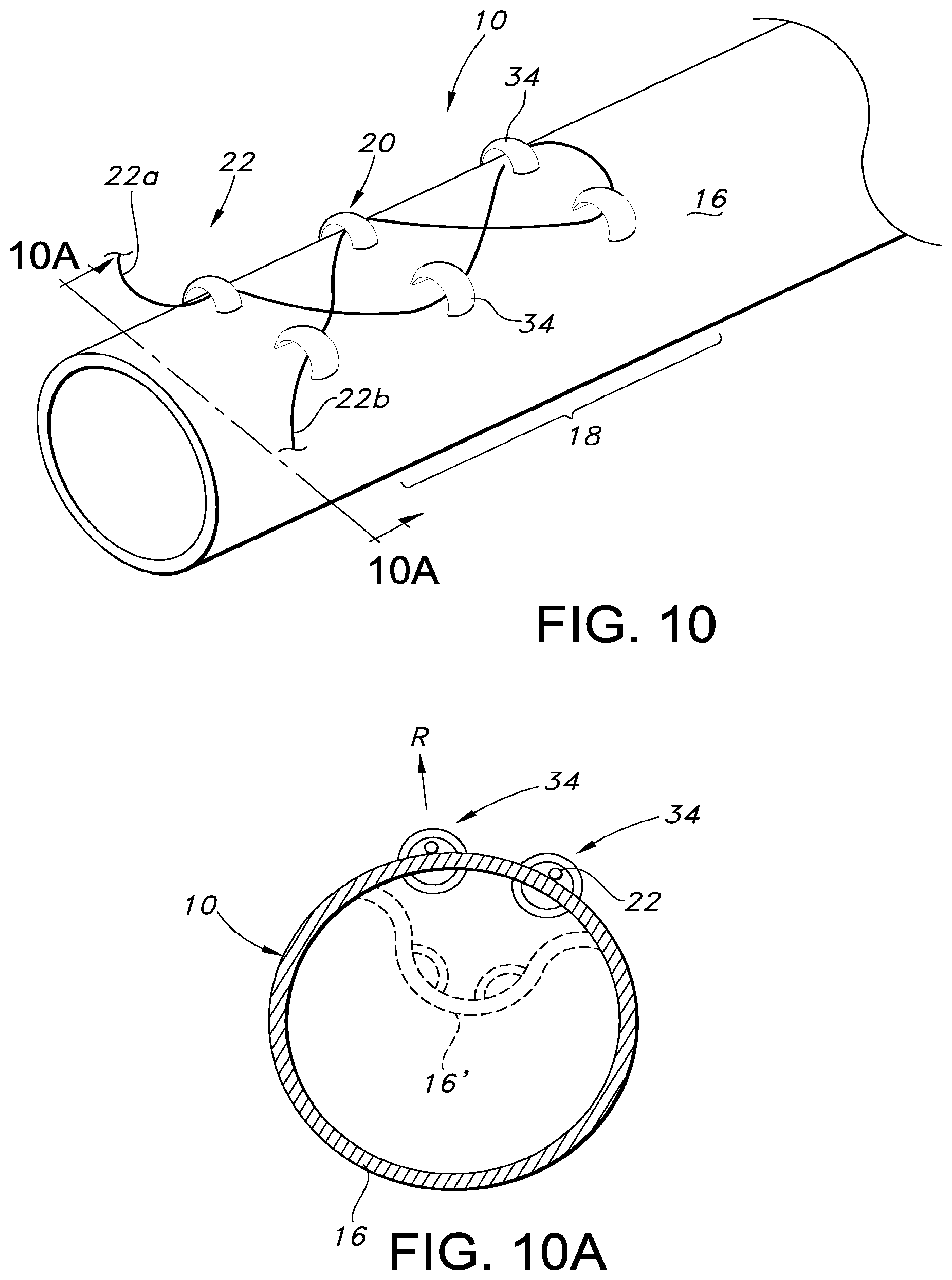 Patent US12097109 Figure 5 – Adjustable vascular graft for custom inner diameter reduction and related methods