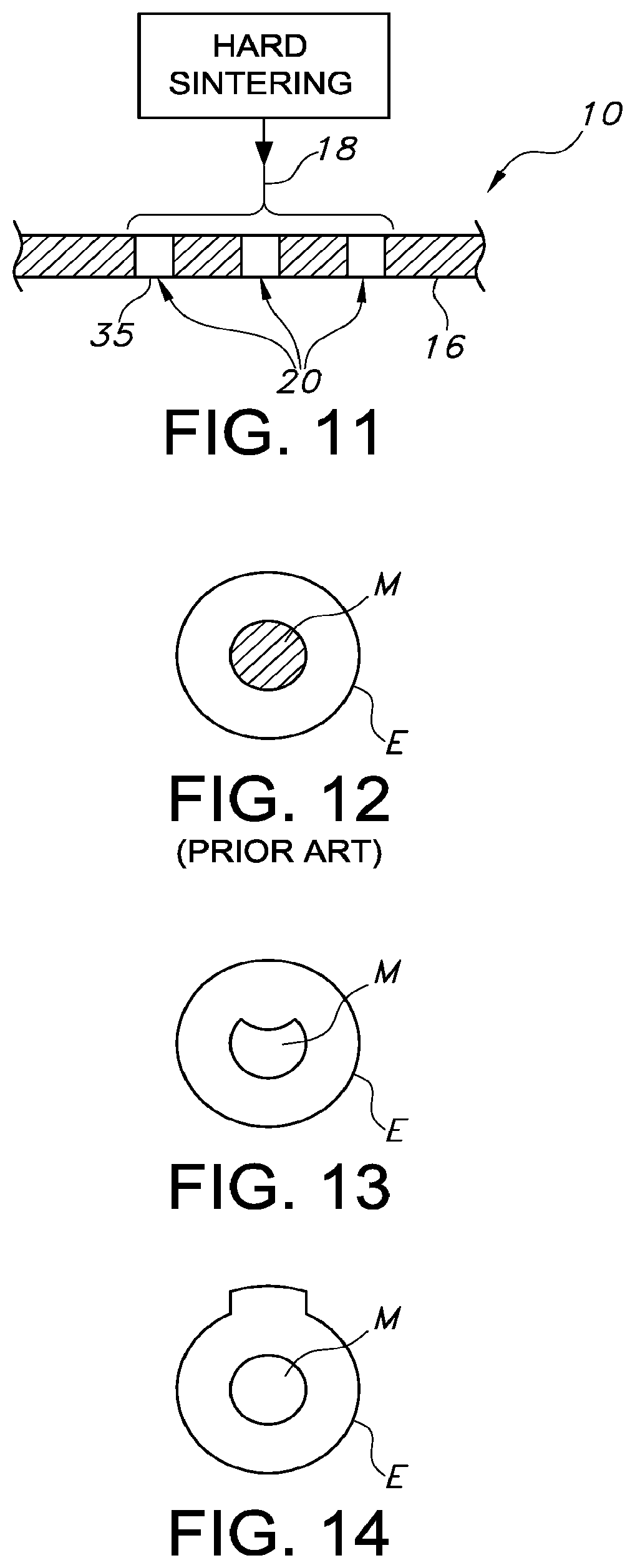 Patent US12097109 Figure 6 – Adjustable vascular graft for custom inner diameter reduction and related methods