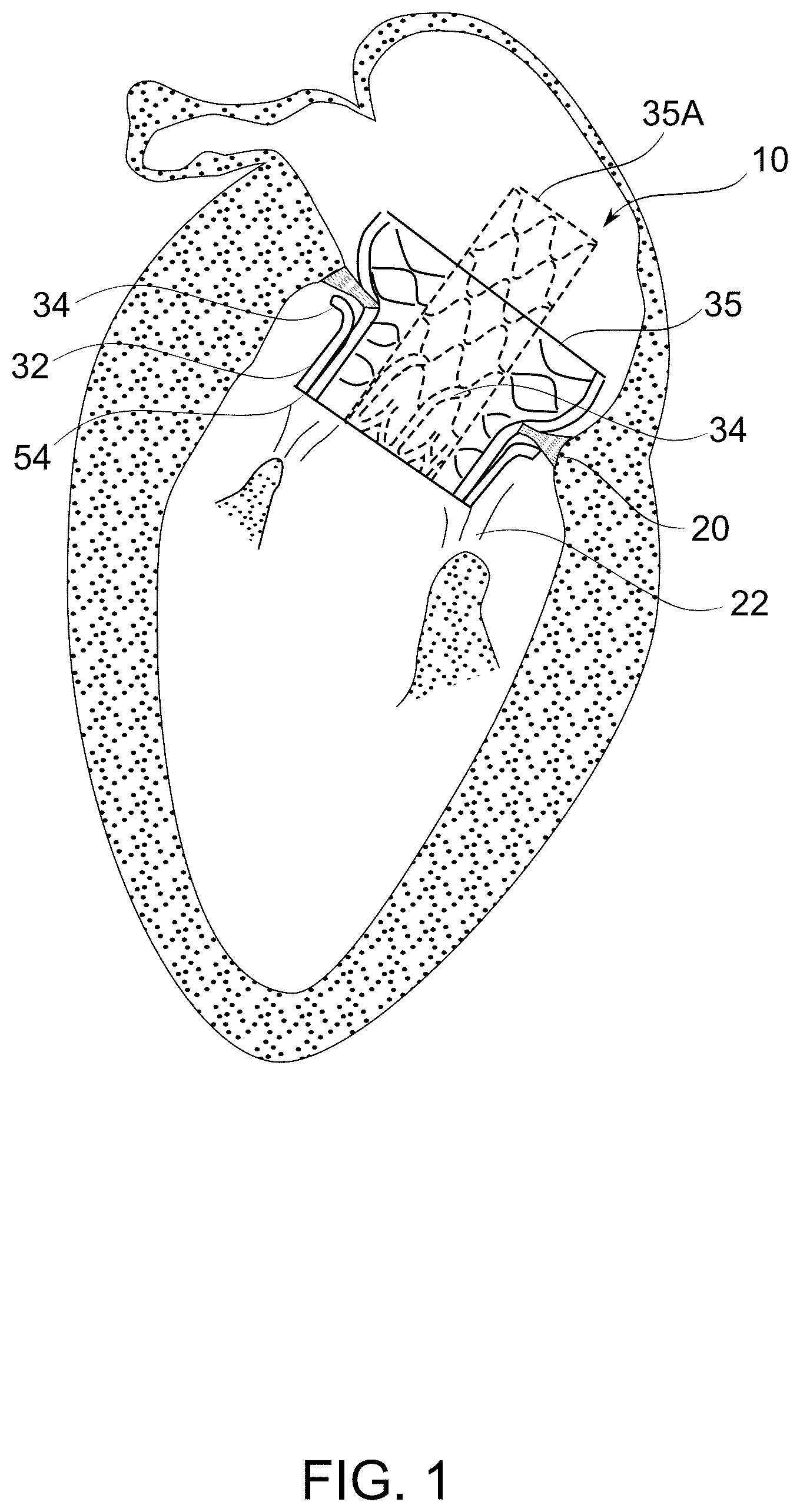 Patent US12097114 Figure 1 – Ventricular structure reshaping atrio-ventricular valve