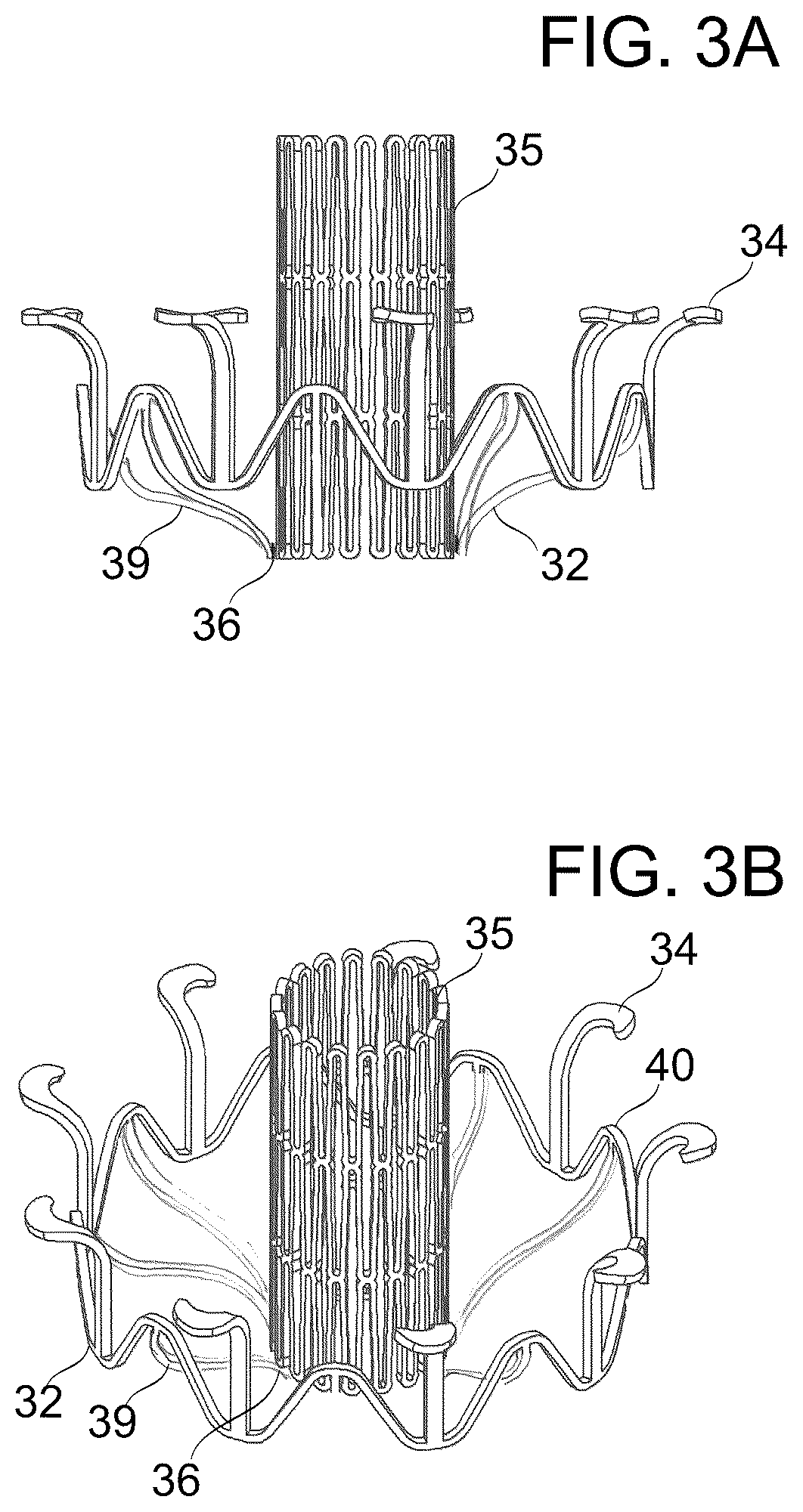 Patent US12097114 Figure 3 – Ventricular structure reshaping atrio-ventricular valve