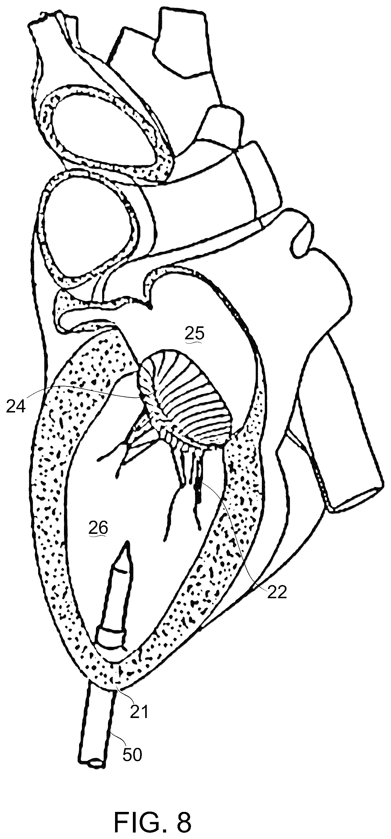 Patent US12097114 Figure 10 – Ventricular structure reshaping atrio-ventricular valve