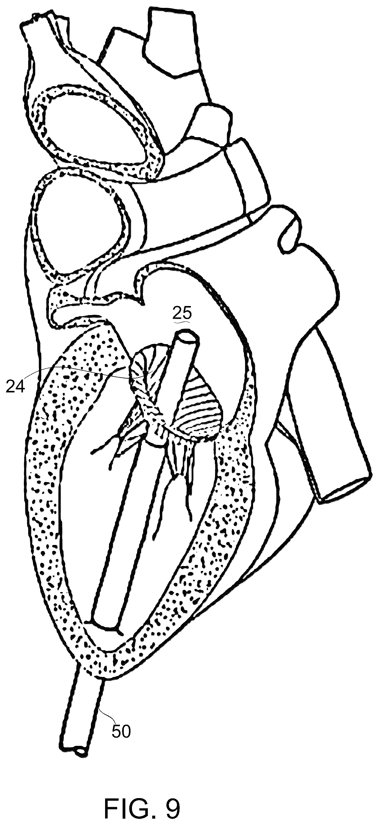 Patent US12097114 Figure 11 – Ventricular structure reshaping atrio-ventricular valve
