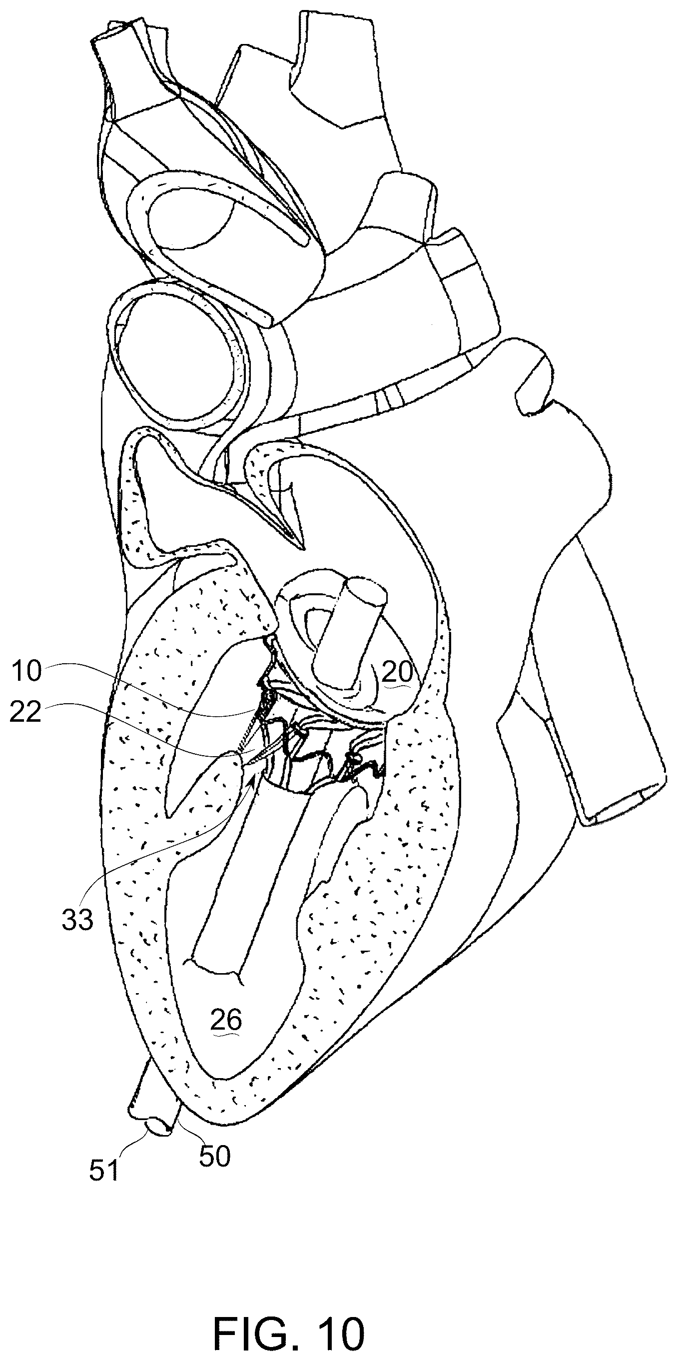 Patent US12097114 Figure 12 – Ventricular structure reshaping atrio-ventricular valve