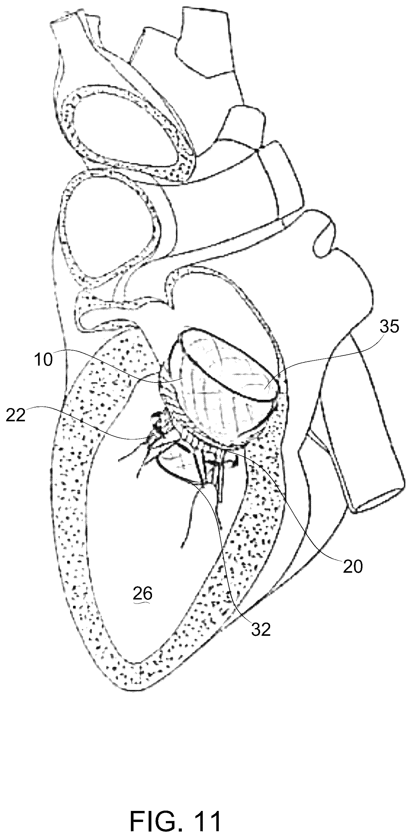 Patent US12097114 Figure 13 – Ventricular structure reshaping atrio-ventricular valve