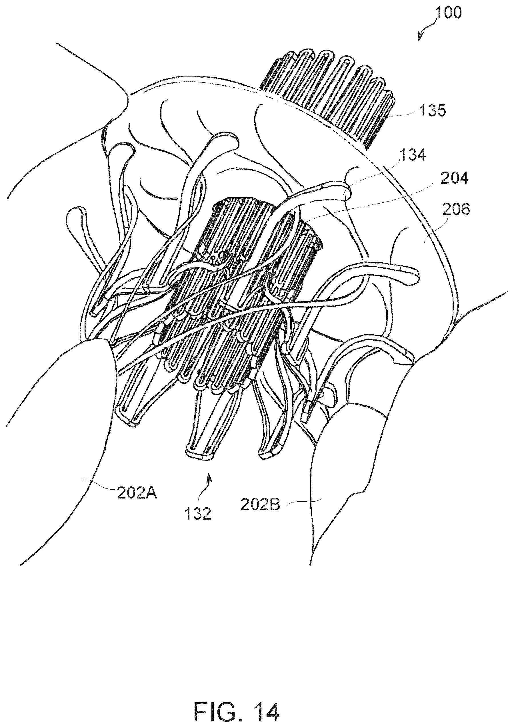 Patent US12097114 Figure 18 – Ventricular structure reshaping atrio-ventricular valve