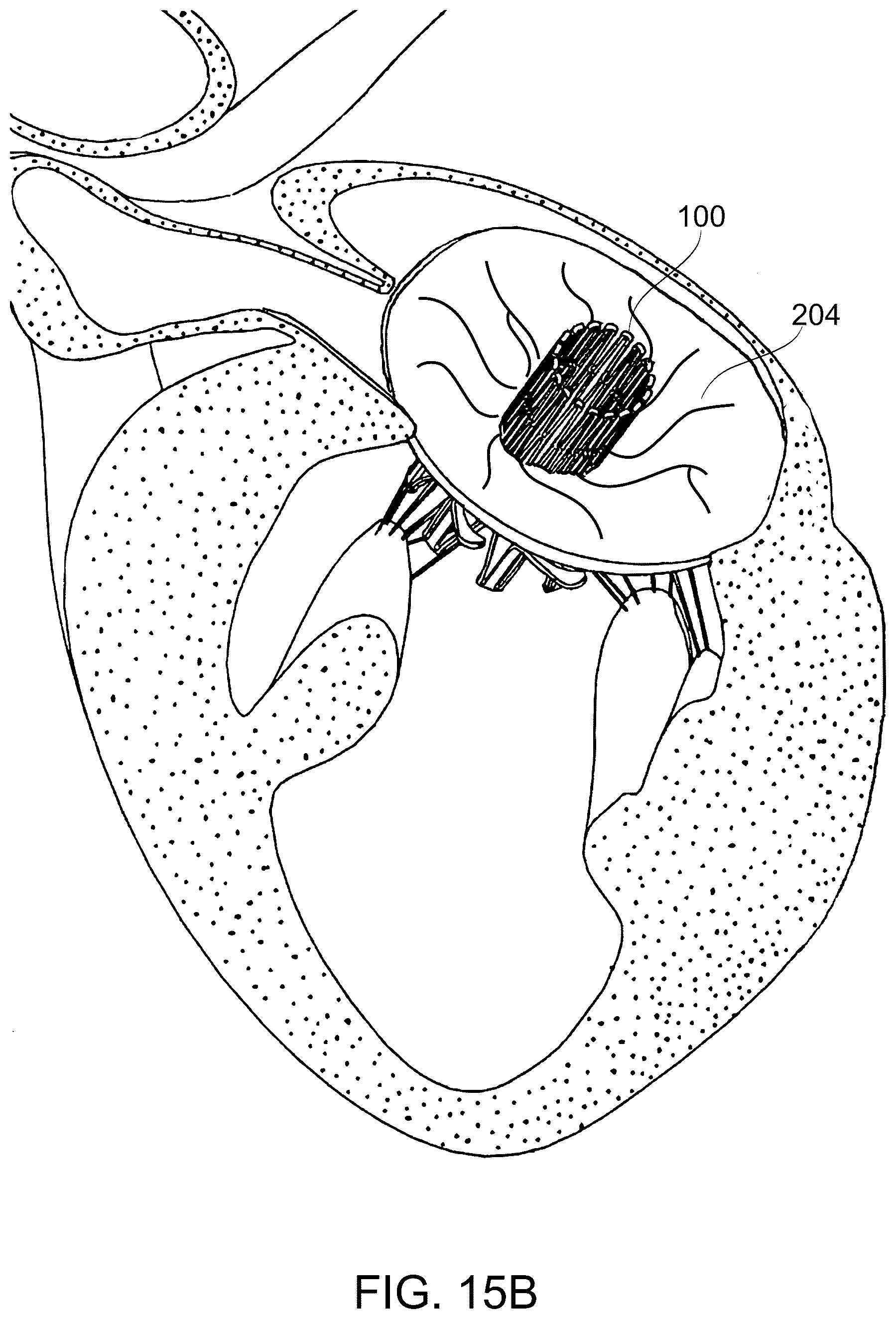Patent US12097114 Figure 20 – Ventricular structure reshaping atrio-ventricular valve