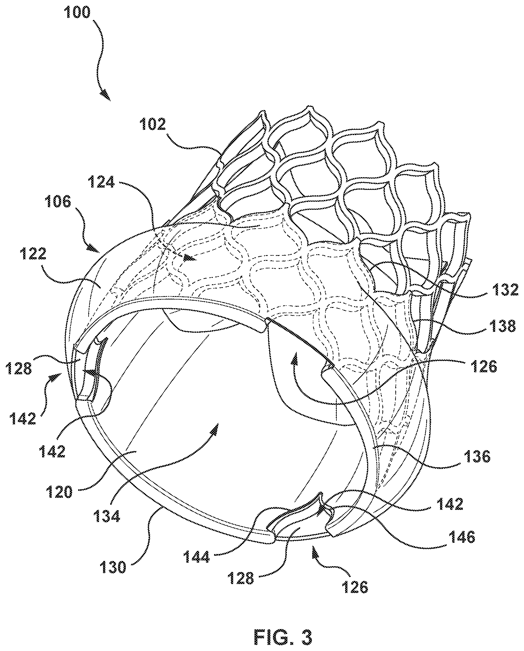 Patent US12097115 Figure 3 – Prosthesis with anti-paravalvular leakage component including a one-way valve