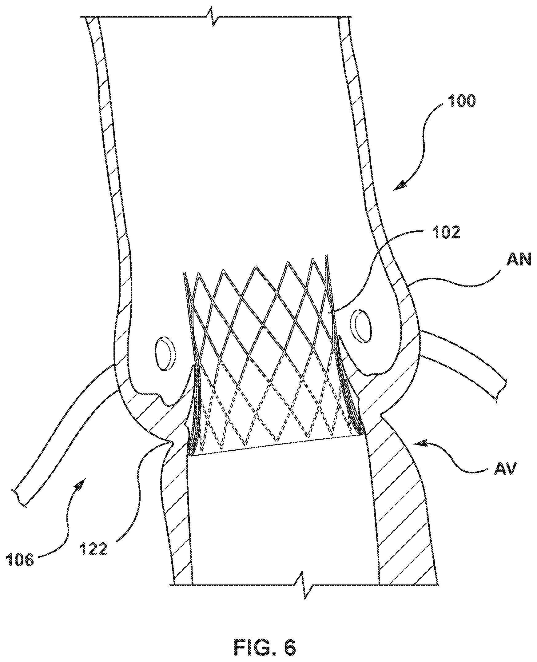 Patent US12097115 Figure 6 – Prosthesis with anti-paravalvular leakage component including a one-way valve