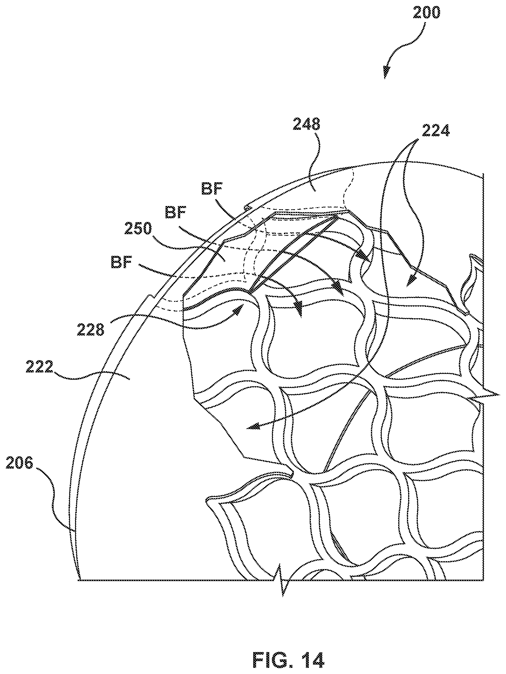 Patent US12097115 Figure 17 – Prosthesis with anti-paravalvular leakage component including a one-way valve