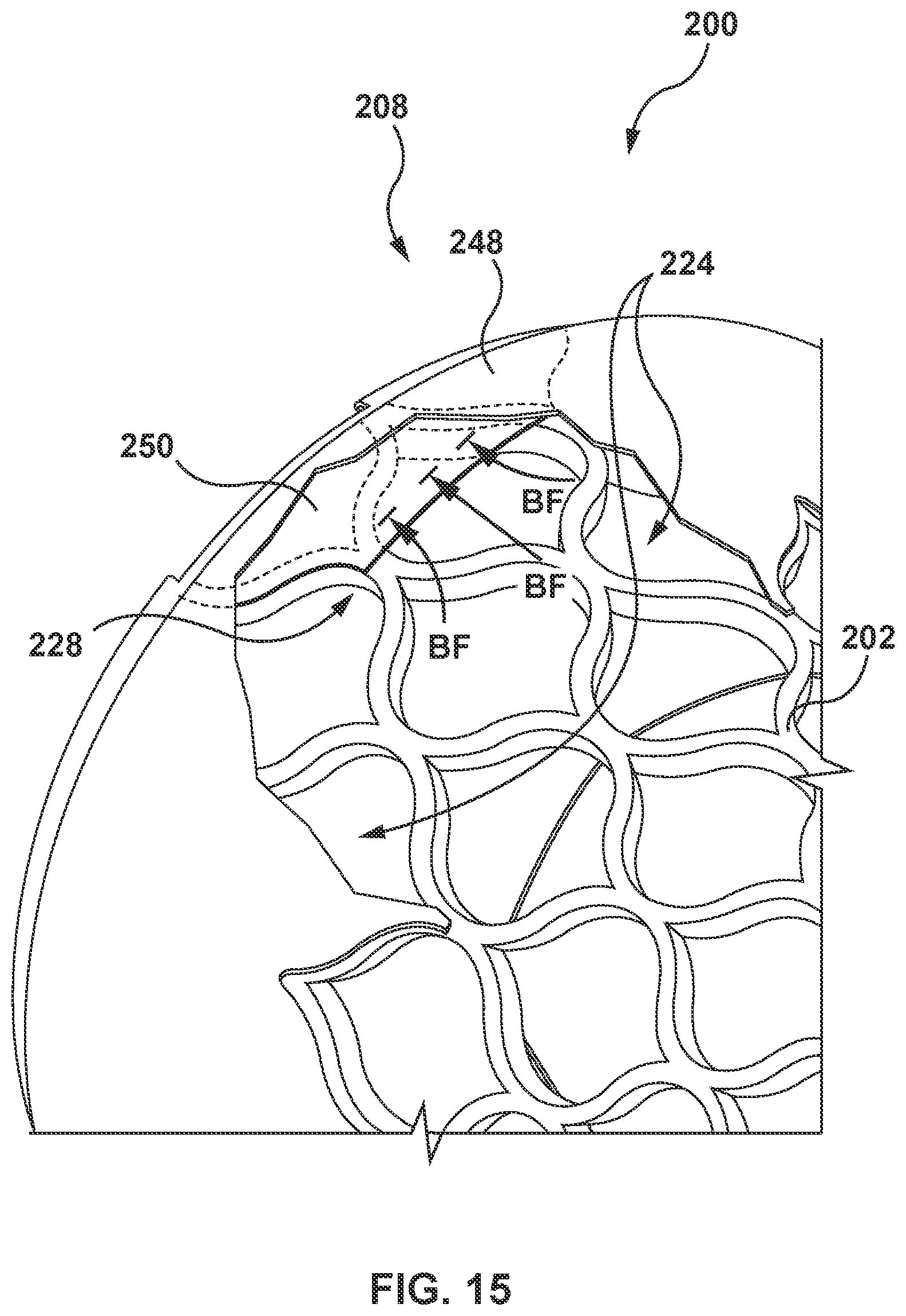 Patent US12097115 Figure 18 – Prosthesis with anti-paravalvular leakage component including a one-way valve