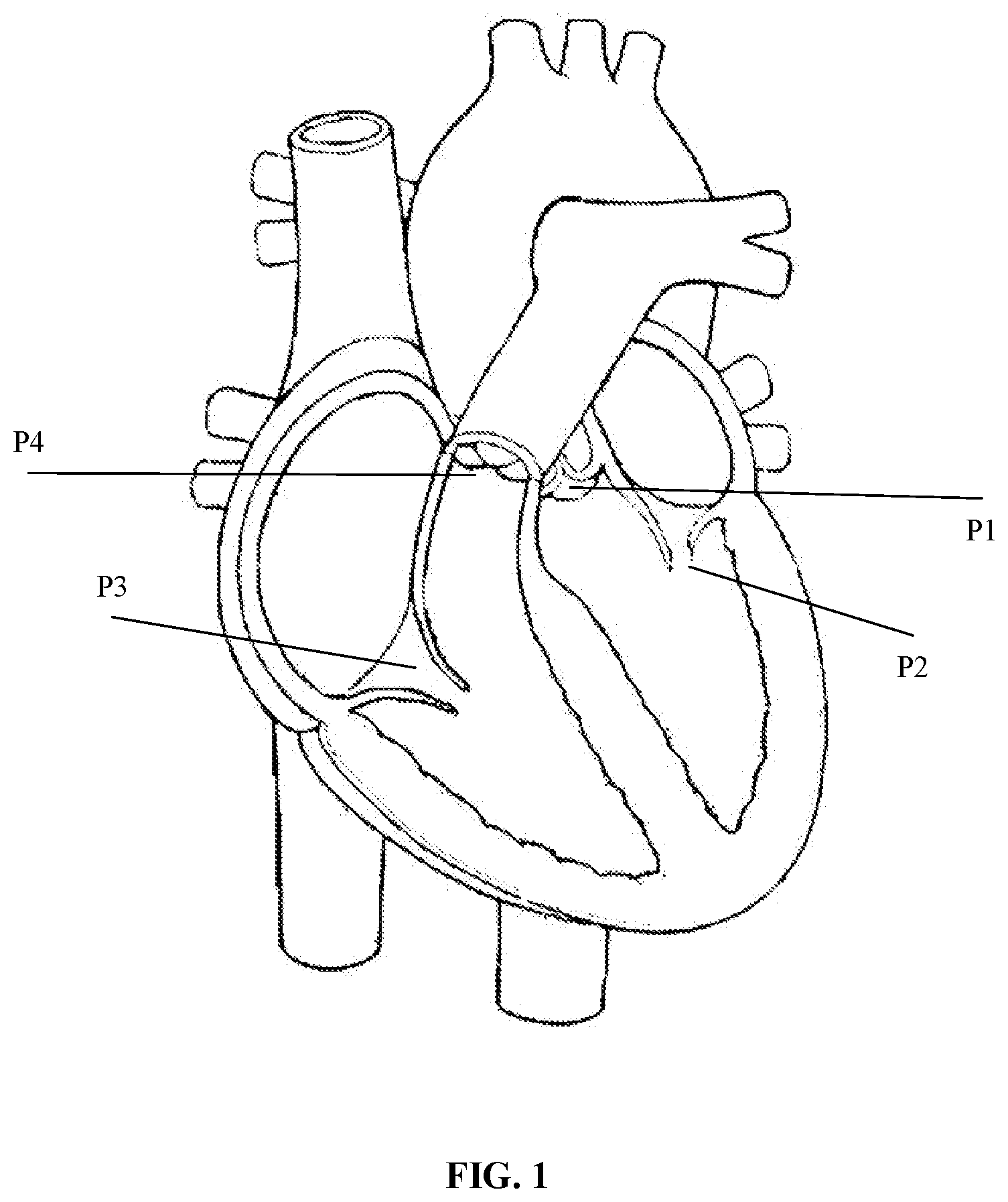 Patent US12097116 — Prosthetic heart valve for multiple positions and assembling method thereof — Figure 1