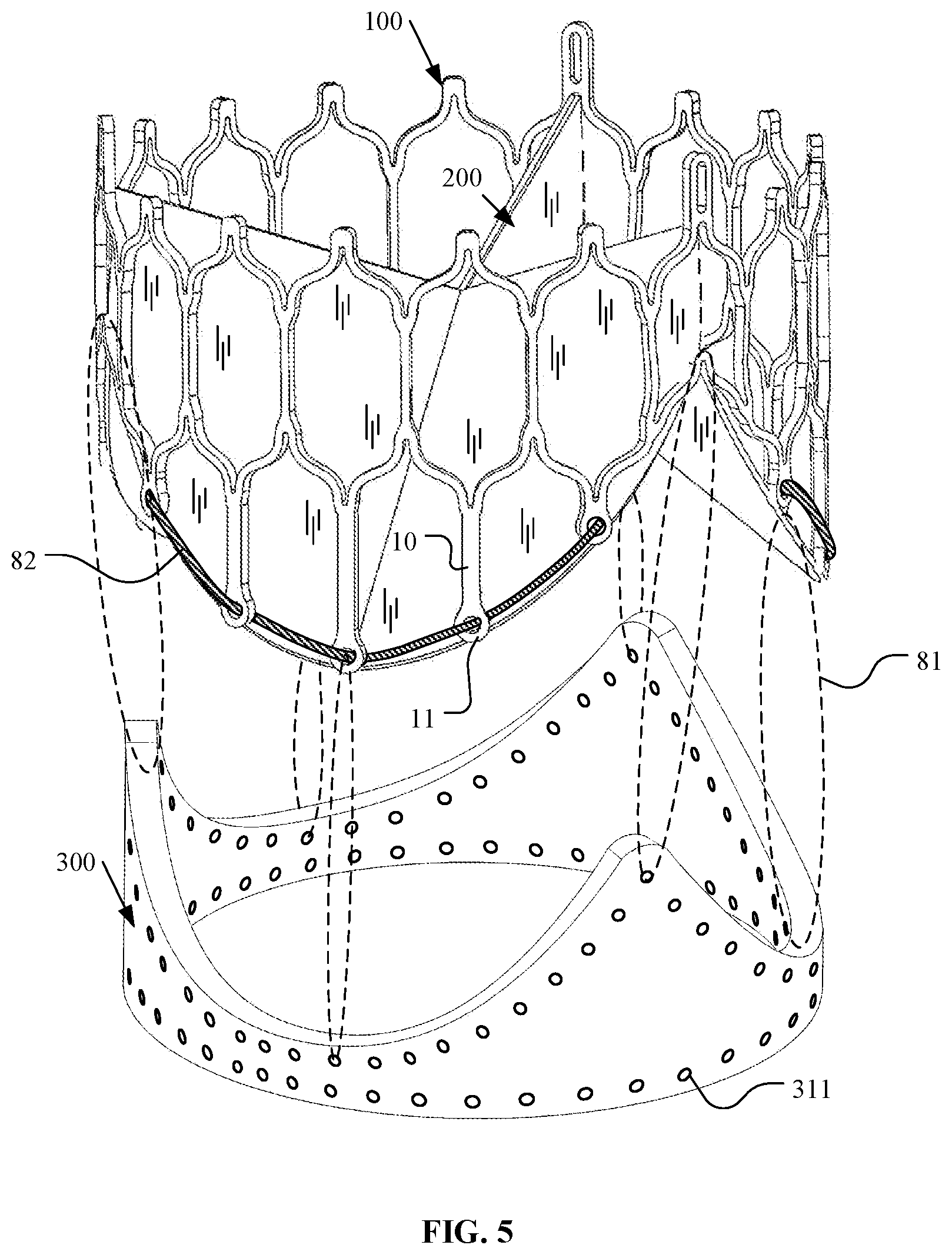 Patent US12097116 Figure 5 – Prosthetic heart valve for multiple positions and assembling method thereof