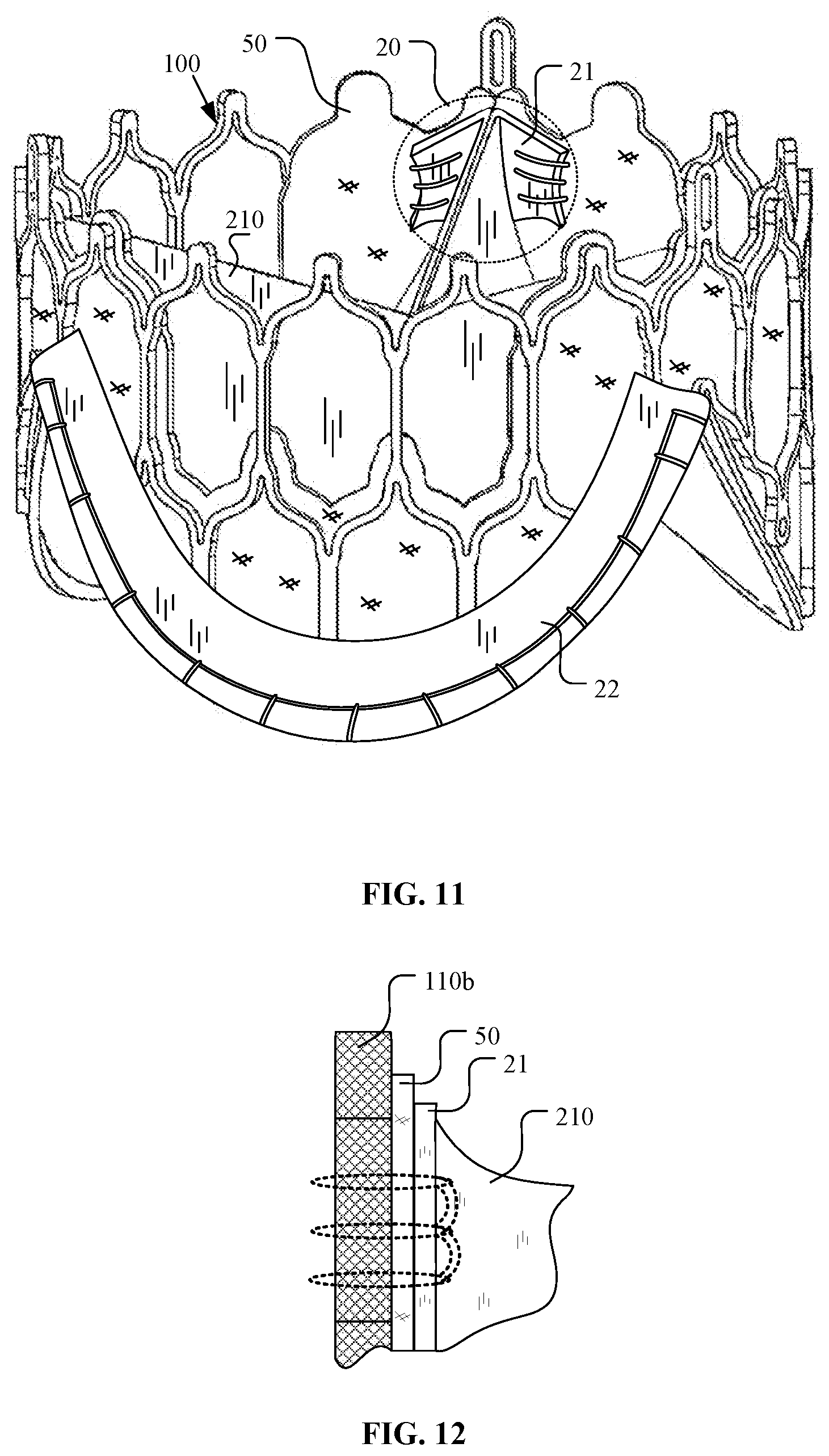 Patent US12097116 Figure 10 – Prosthetic heart valve for multiple positions and assembling method thereof