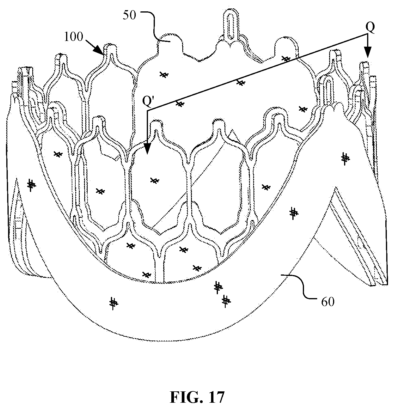 Patent US12097116 Figure 13 – Prosthetic heart valve for multiple positions and assembling method thereof