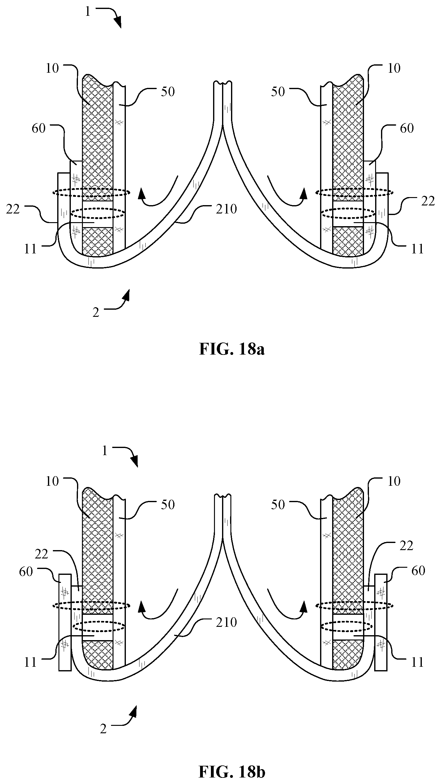 Patent US12097116 Figure 14 – Prosthetic heart valve for multiple positions and assembling method thereof