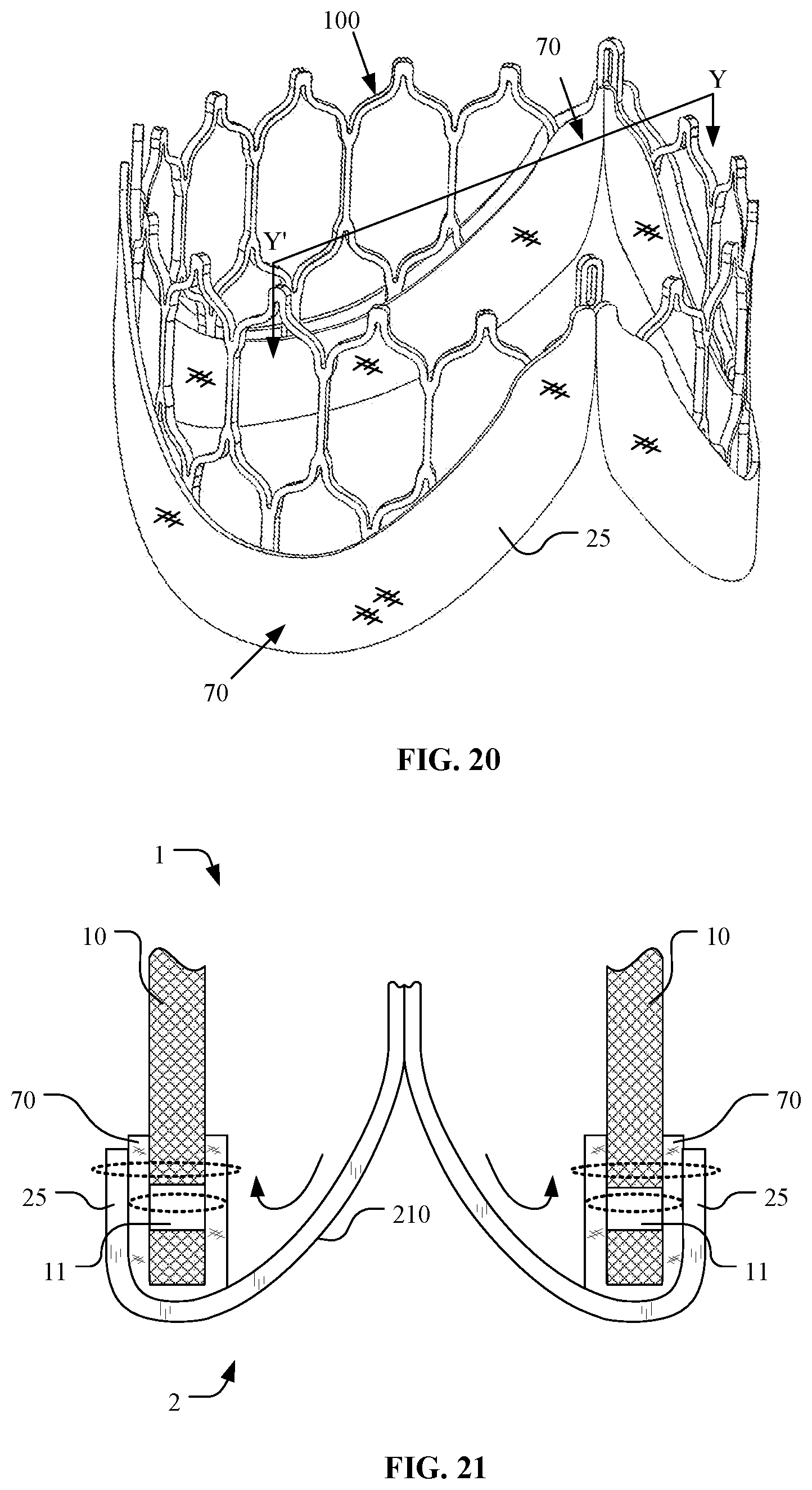 Patent US12097116 Figure 16 – Prosthetic heart valve for multiple positions and assembling method thereof