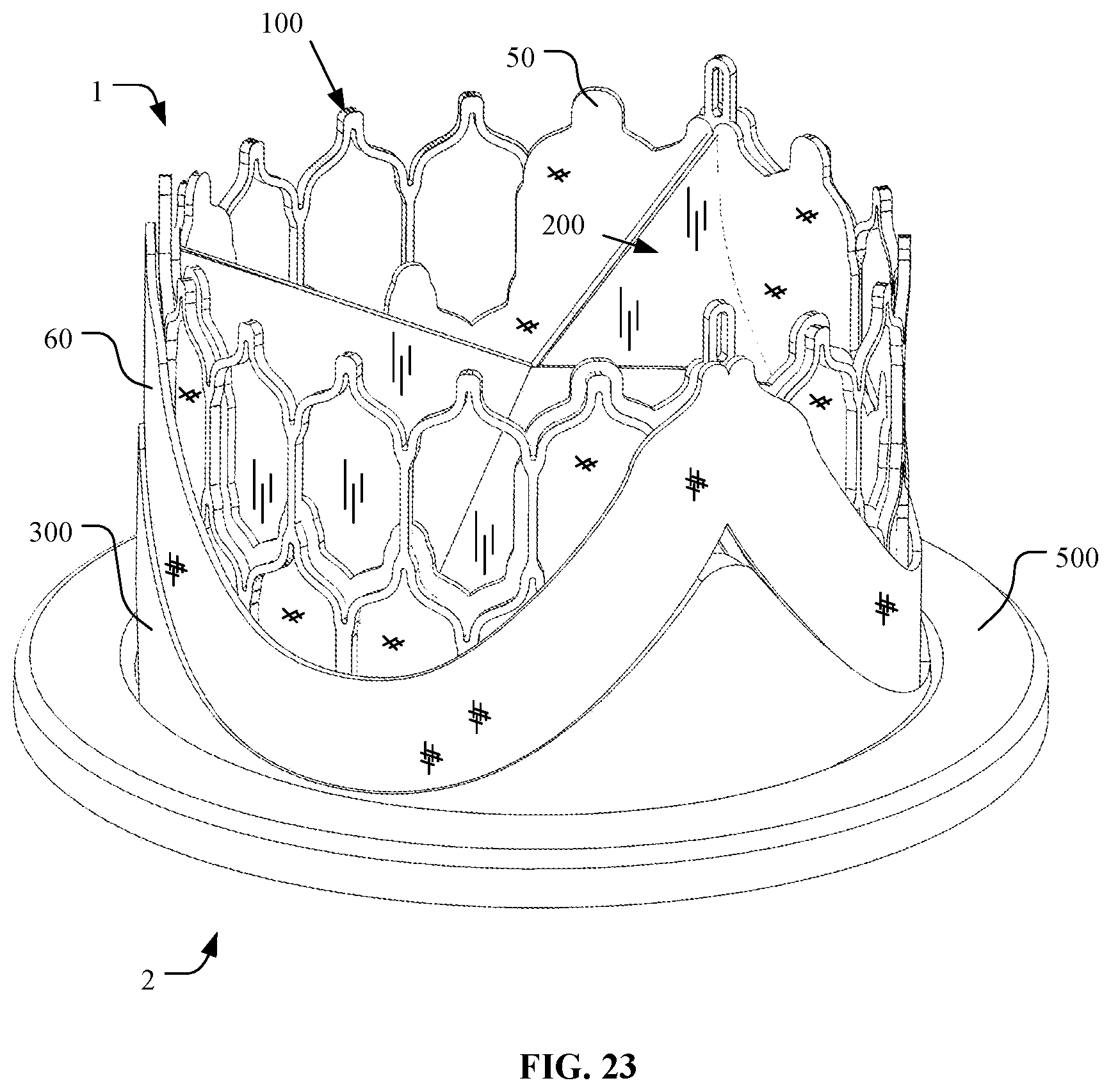 Patent US12097116 Figure 18 – Prosthetic heart valve for multiple positions and assembling method thereof