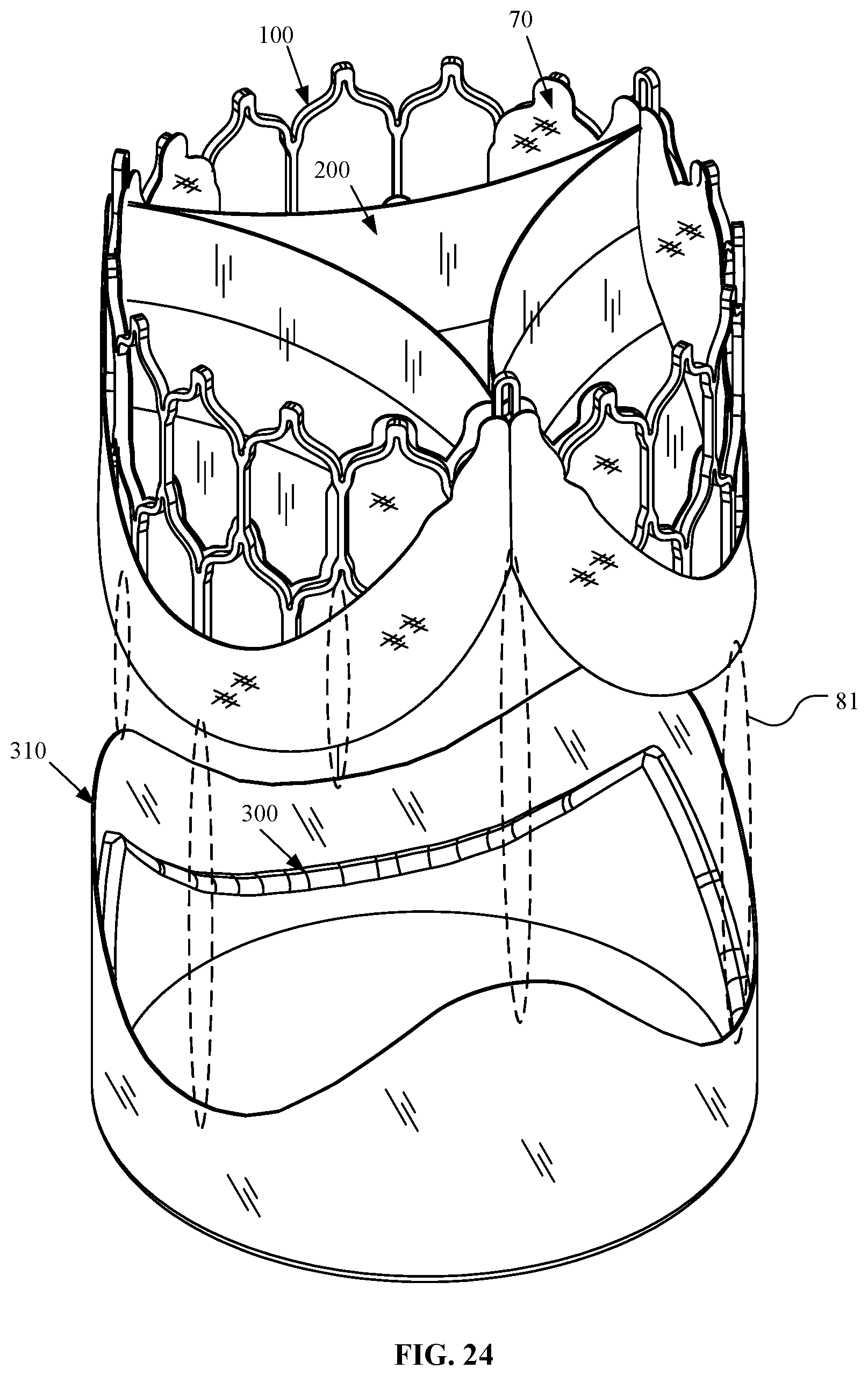 Patent US12097116 Figure 19 – Prosthetic heart valve for multiple positions and assembling method thereof