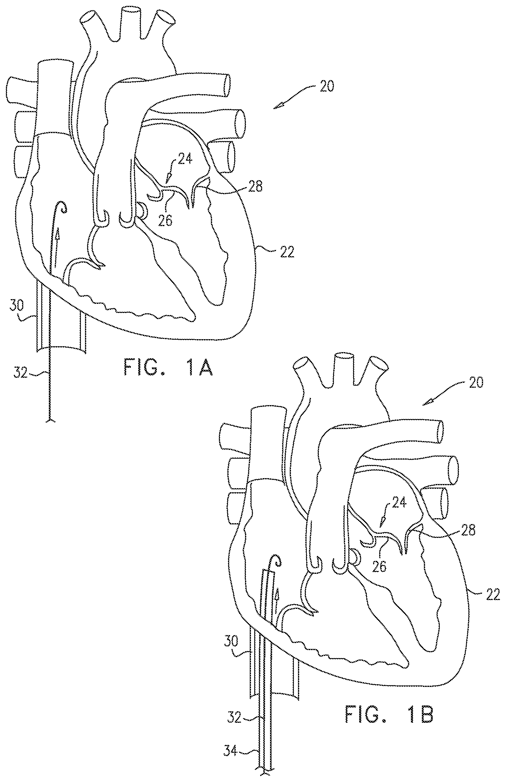 Patent US12097118 Figure 1 – Tissue anchor for heart implant