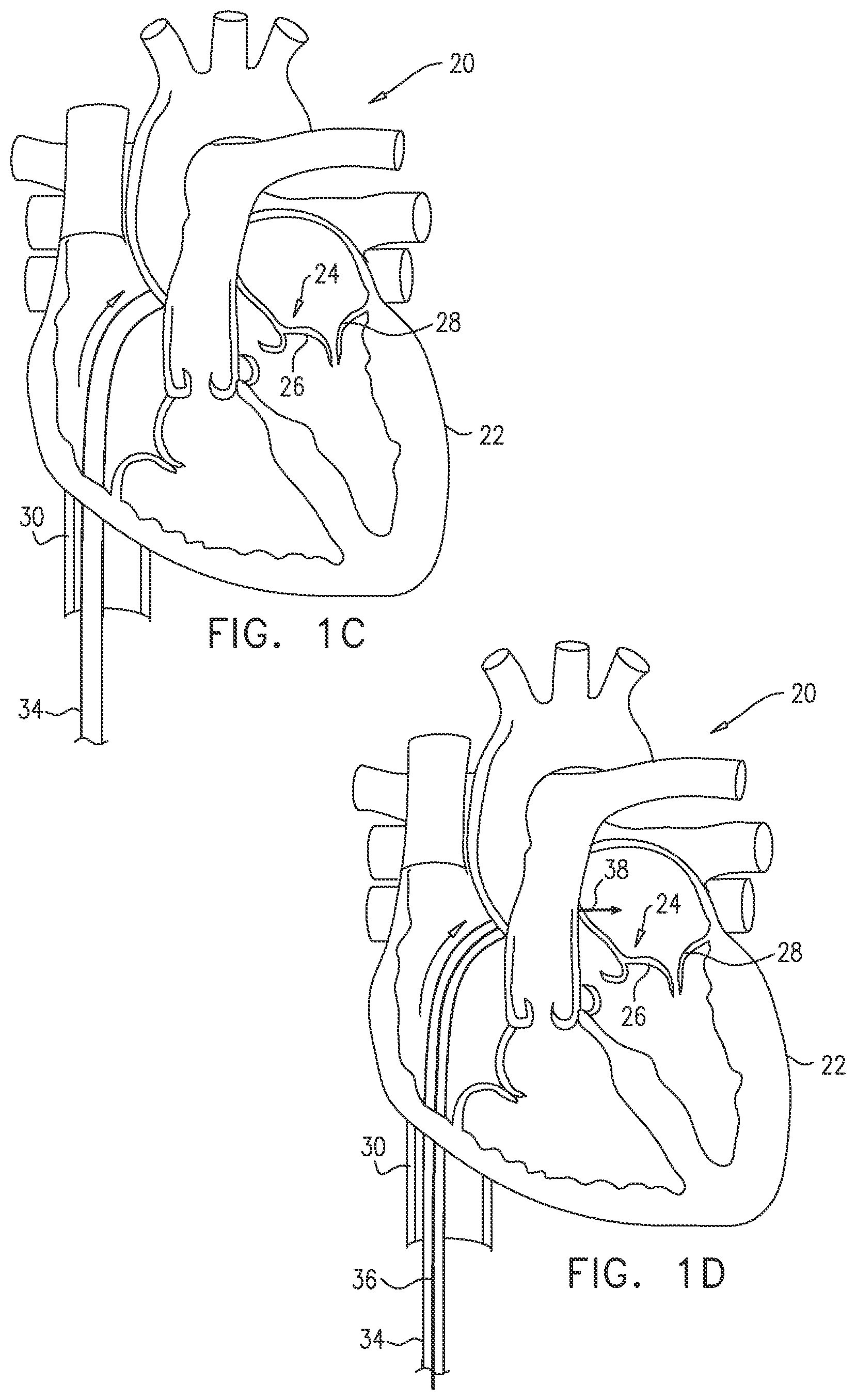 Patent US12097118 Figure 2 – Tissue anchor for heart implant