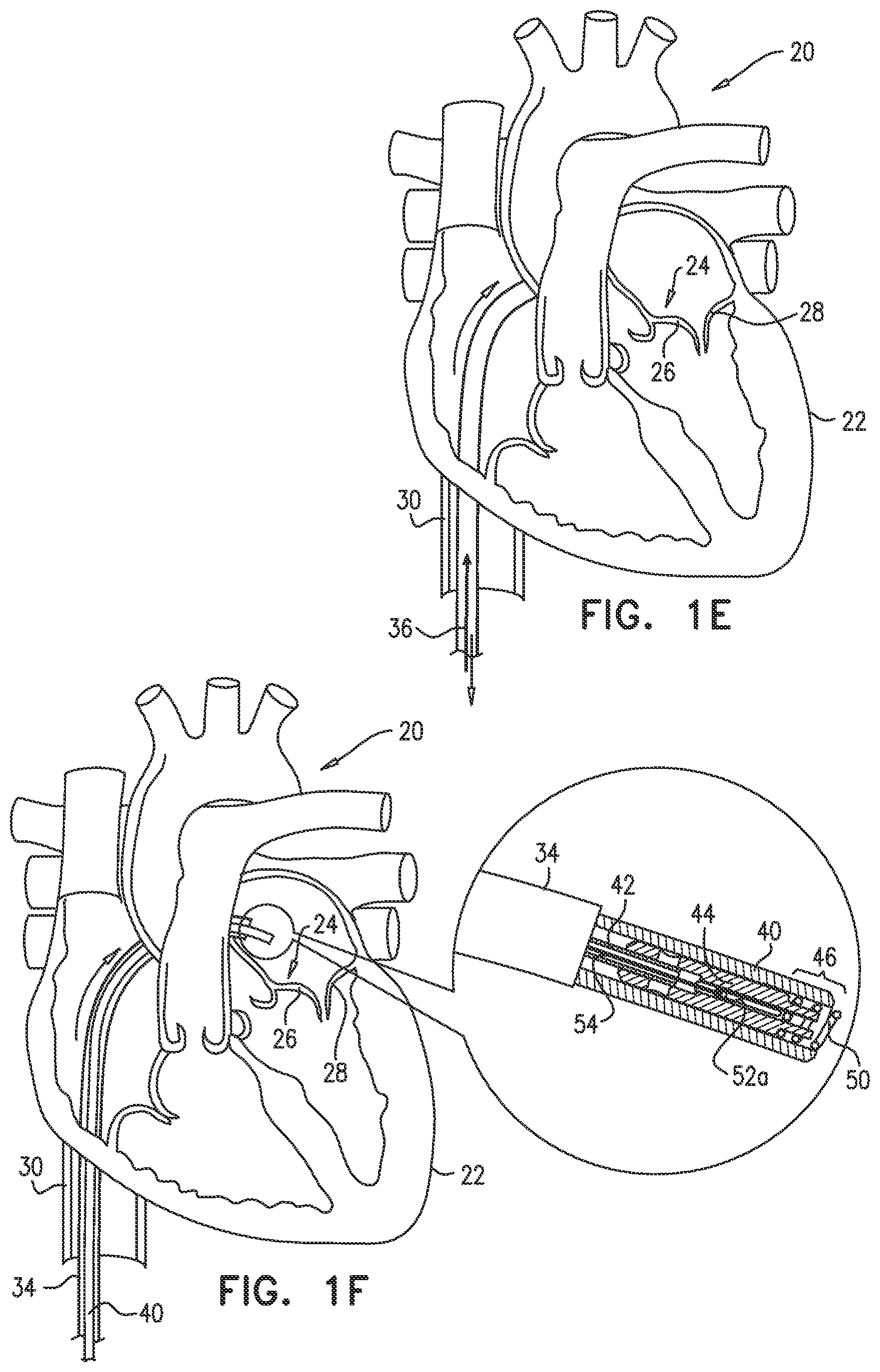 Patent US12097118 Figure 3 – Tissue anchor for heart implant